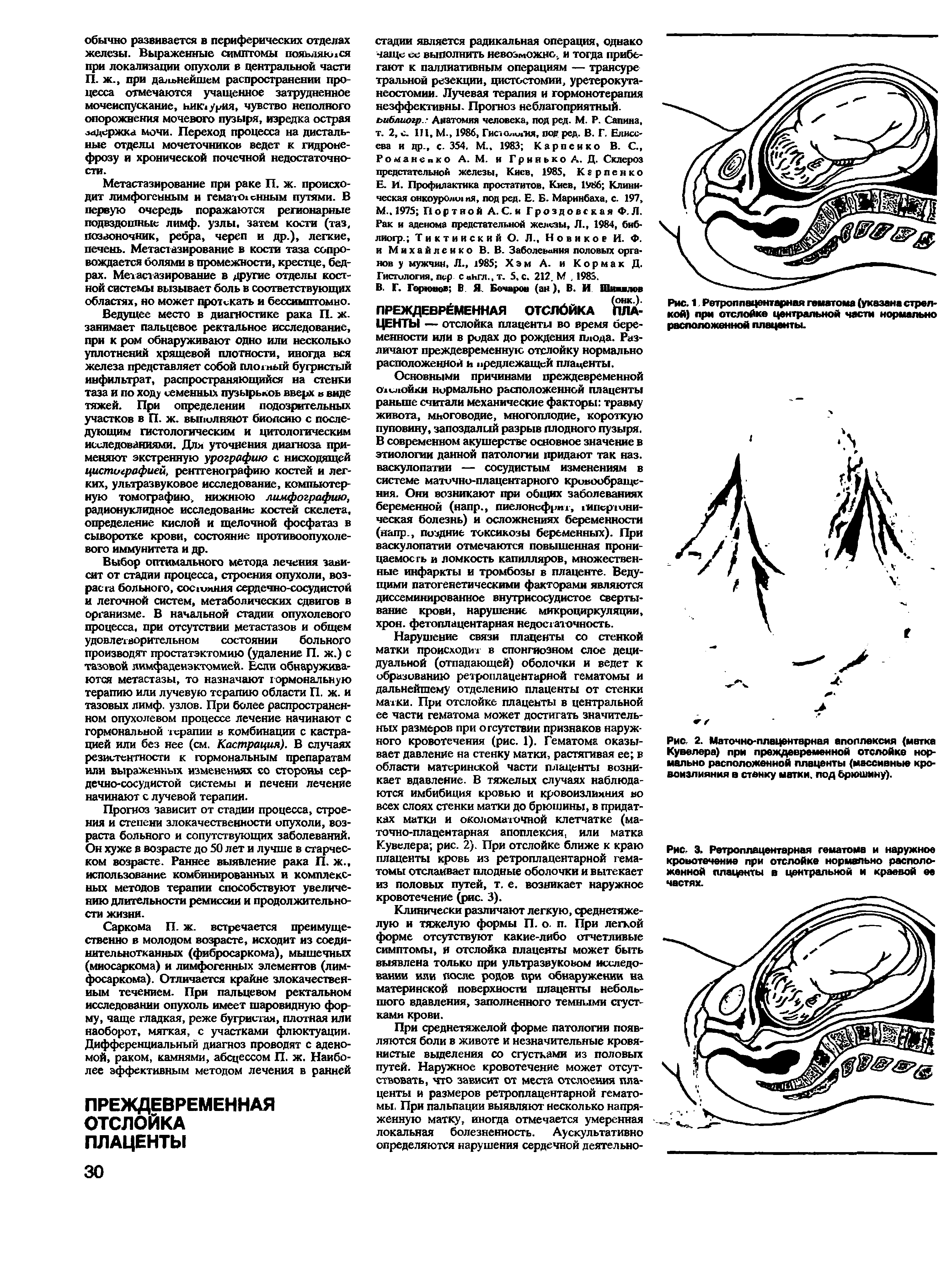 Рис. 2. Маточно-плацентарная апоплексия (метка Кувелера) при преждевременной отслойке нормально расположенной плаценты (массивные кровоизлияния в стенку натки, под брюшину).