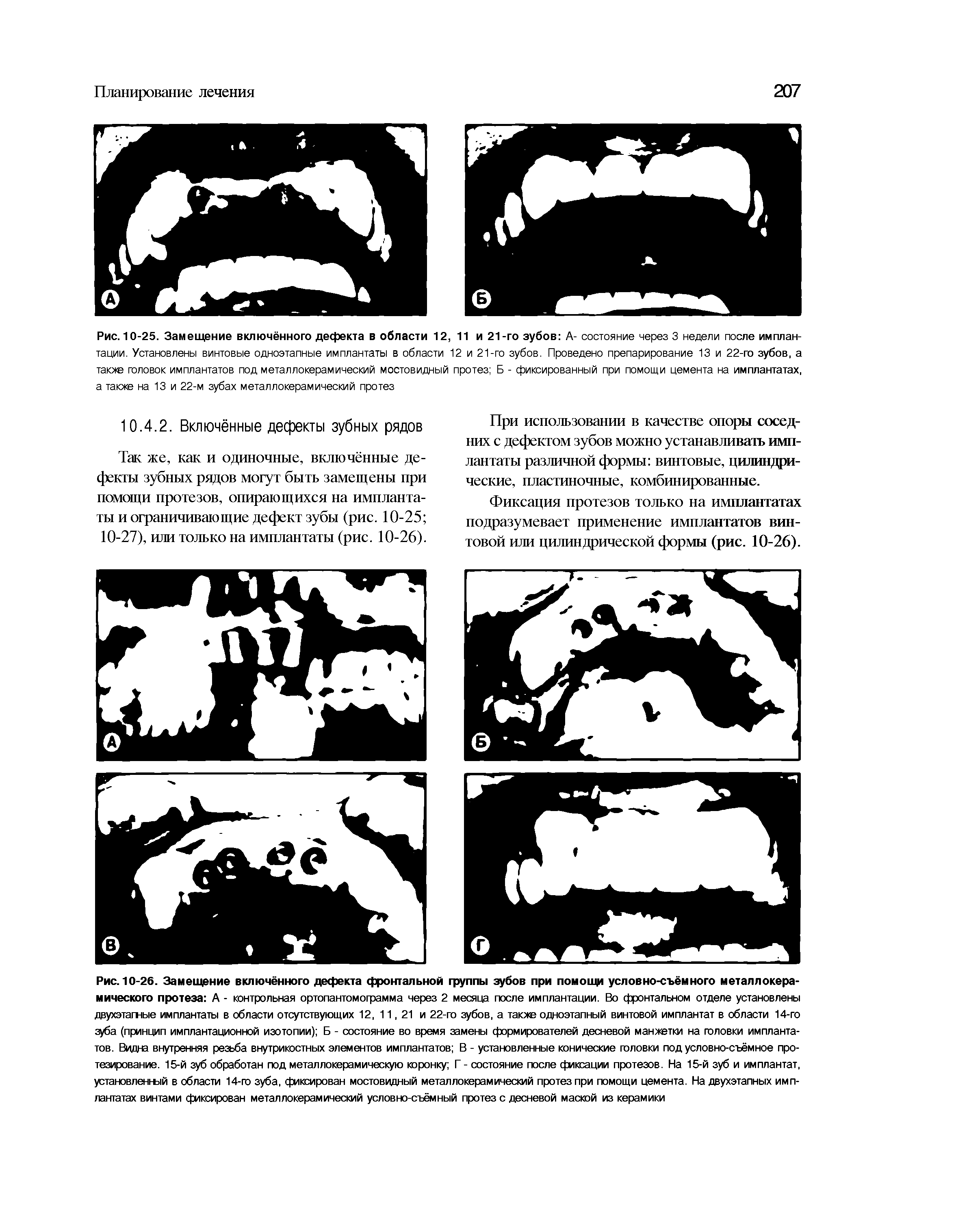 Рис. 10-25. Замещение включённого дефекта в области 12, 11 и 21-го зубов А- состояние через 3 недели после имплантации. Установлены винтовые одноэтапные имплантаты в области 12 и 21-го зубов. Проведено препарирование 13 и 22-го зубов, а также головок имплантатов под металлокерамический мостовидный протез Б - фиксированный при помощи цемента на имплантатах, а также на 13 и 22-м зубах металлокерамический протез...