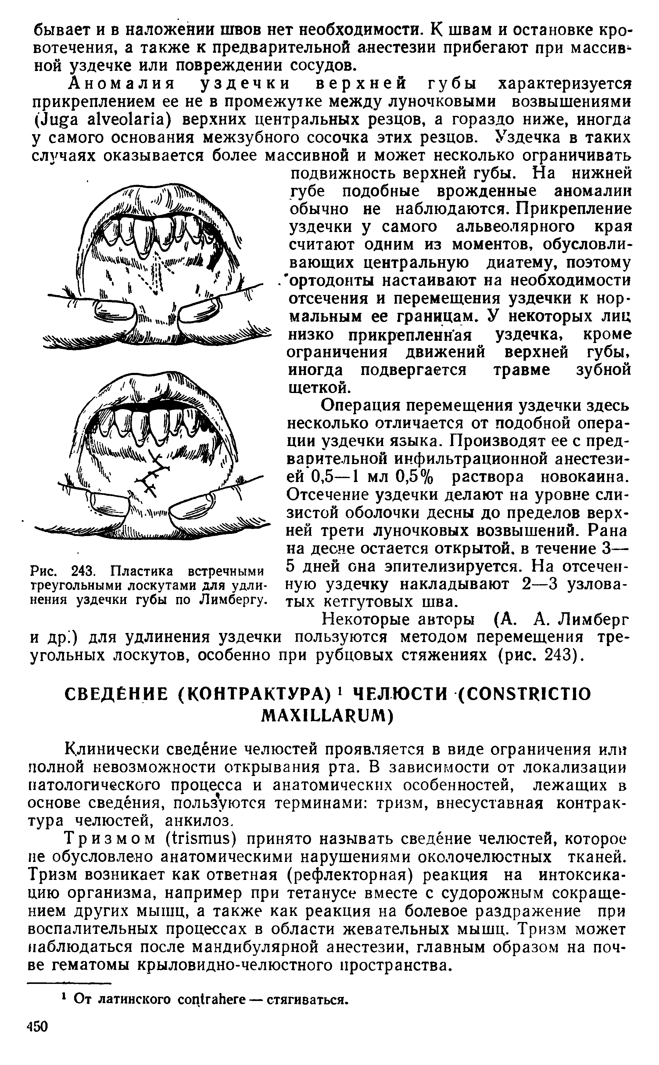 Рис. 243. Пластика встречными треугольными лоскутами для удлинения уздечки губы по Лимбергу.