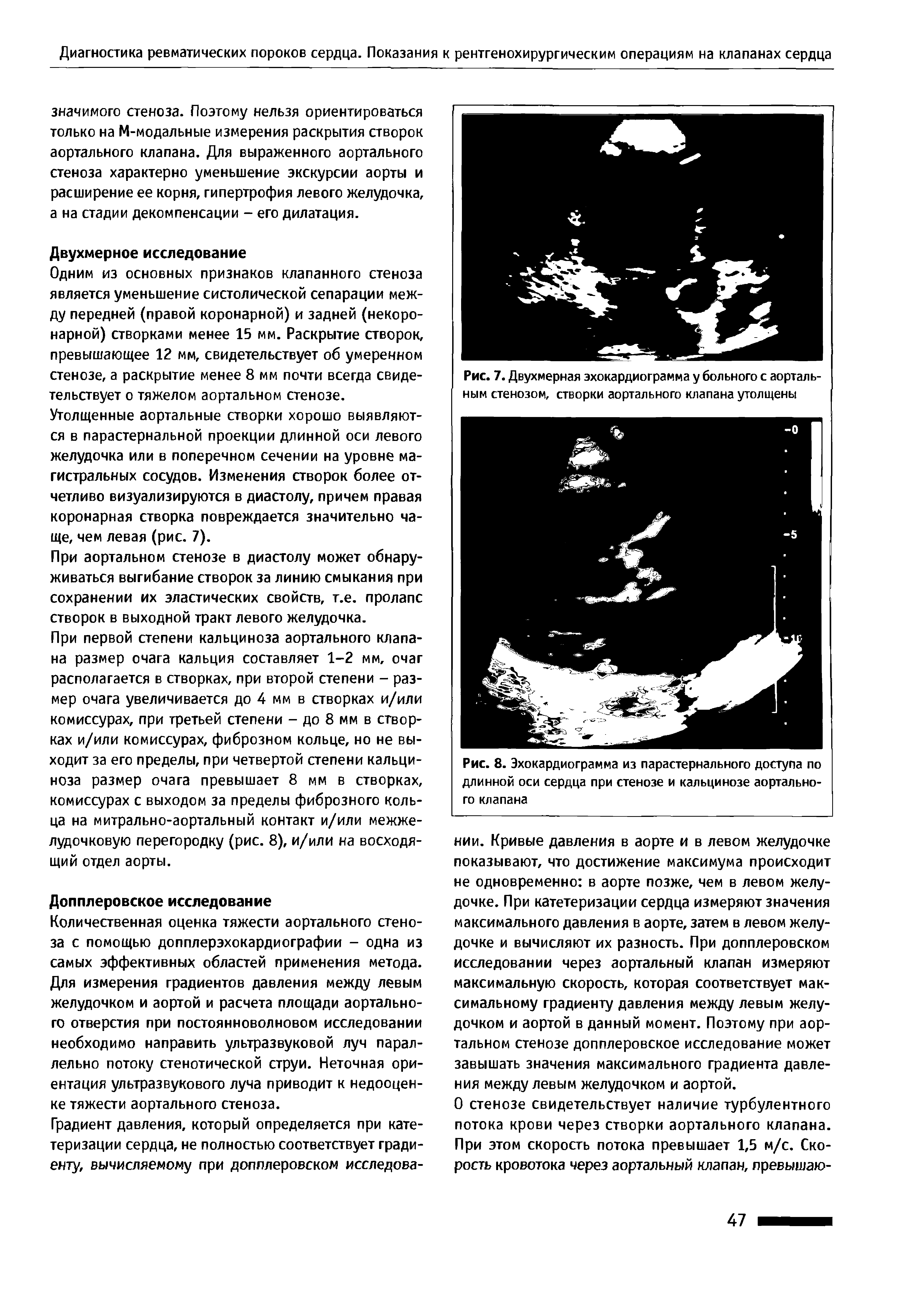 Рис. 7. Двухмерная эхокардиограмма у больного с аортальным стенозом, створки аортального клапана утолщены...