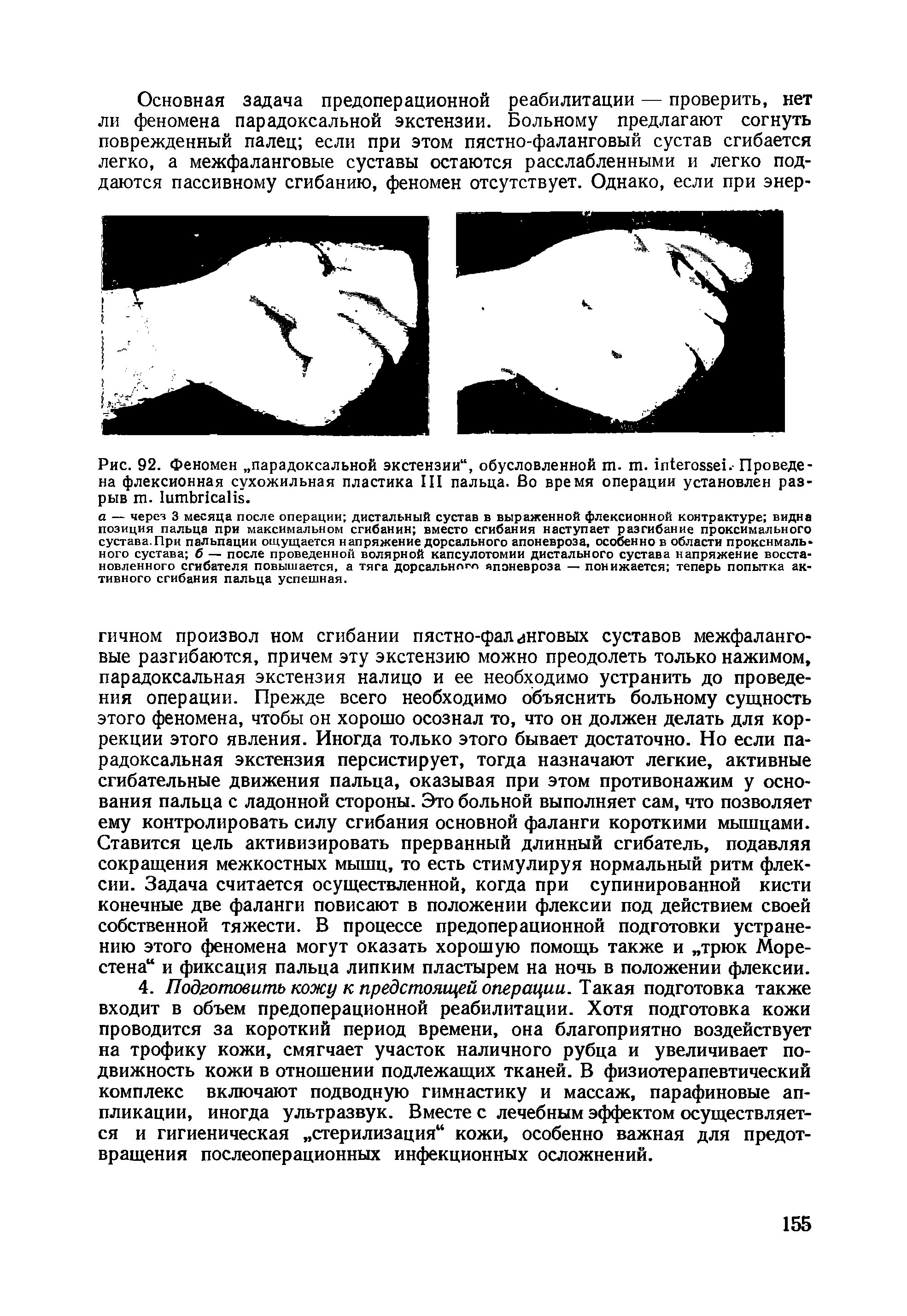 Рис. 92. Феномен парадоксальной экстензии , обусловленной . т. .- Проведена флексионная сухожильная пластика Ш пальца. Во время операции установлен разрыв . .