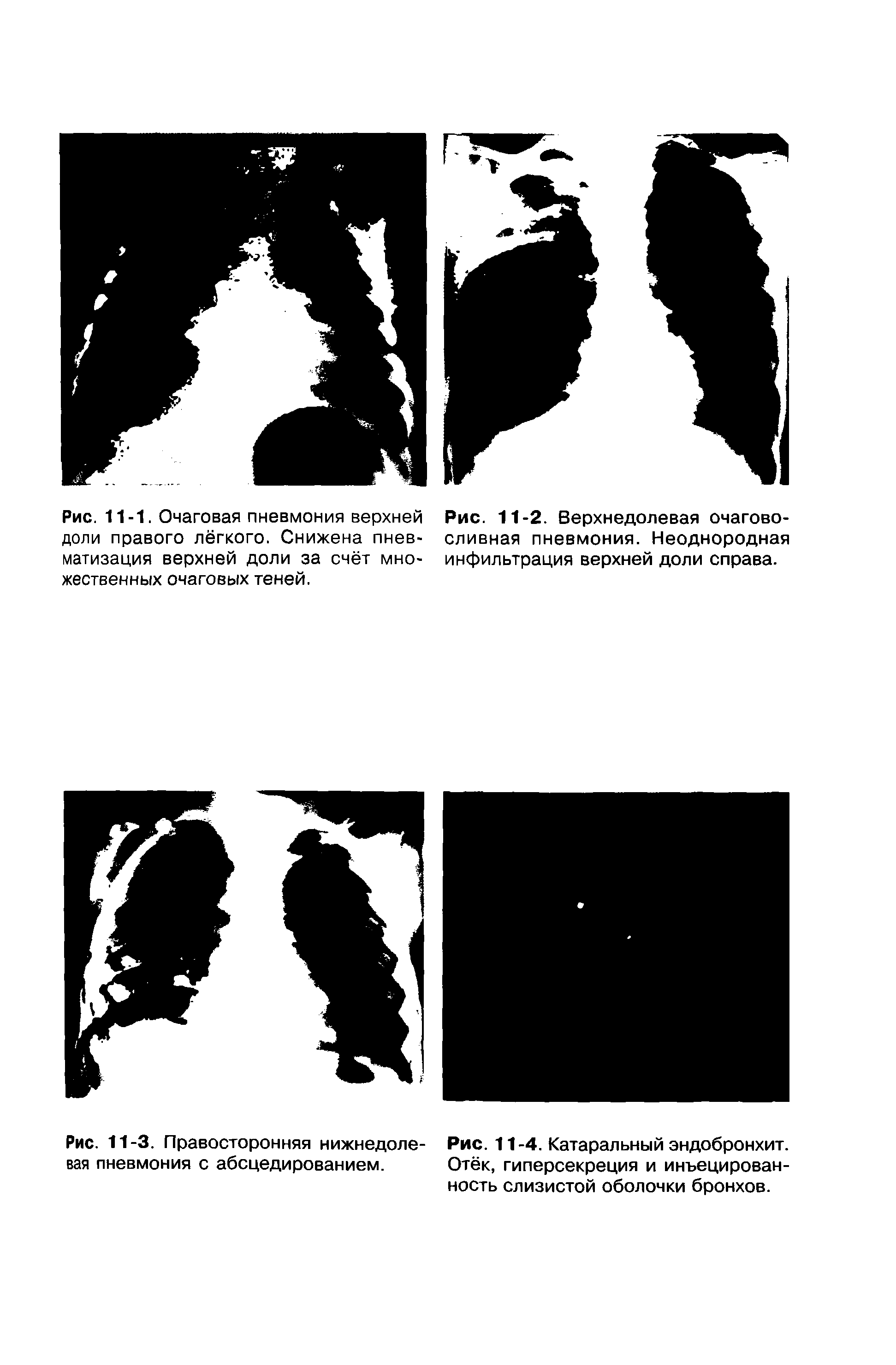 Рис. 11-3. Правосторонняя нижнедоле- Рис. 11-4. Катаральный эндобронхит, вая пневмония с абсцедированием. Отёк, гиперсекреция и инъецированность слизистой оболочки бронхов.