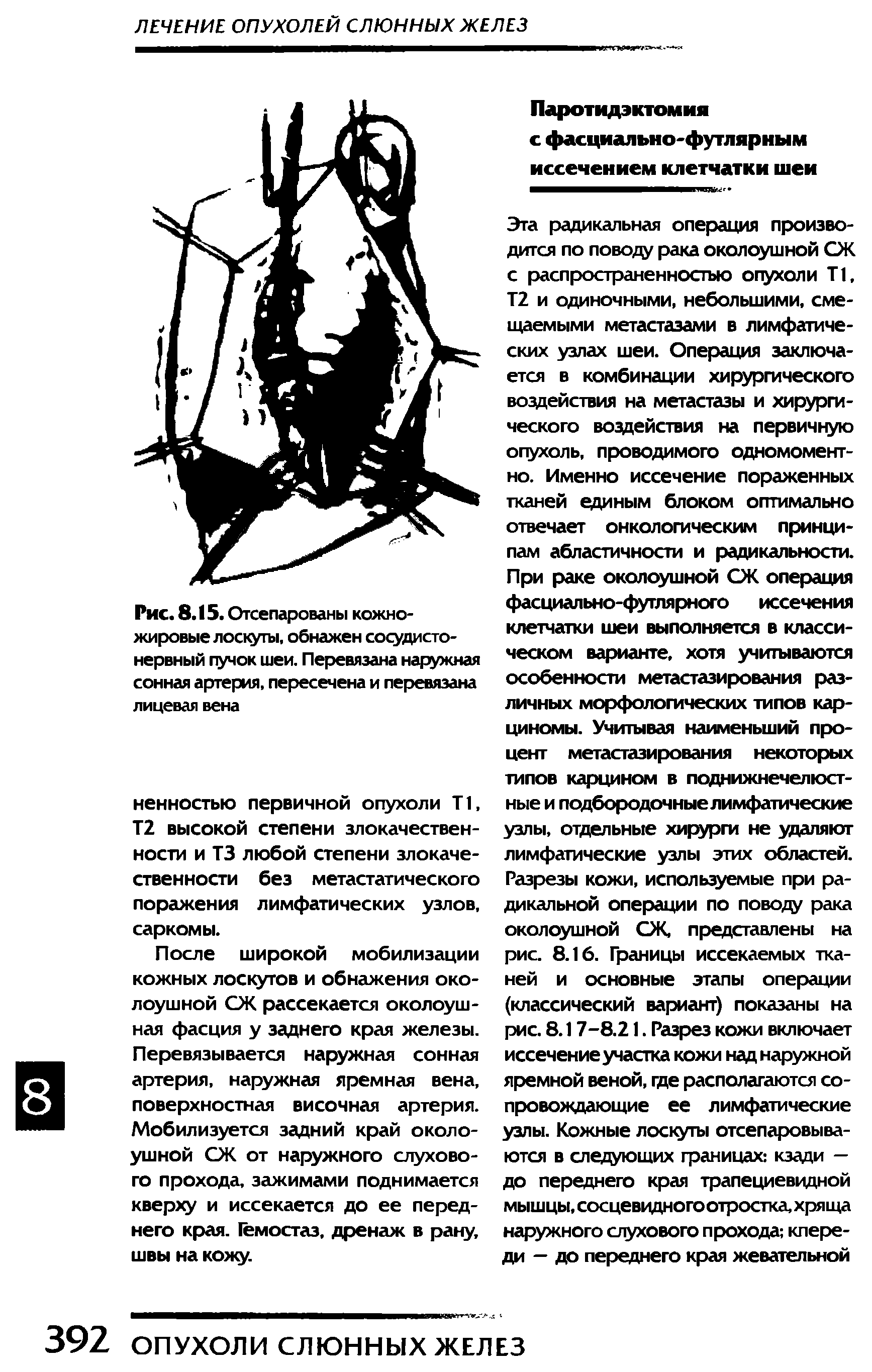 Рис. 8.15. Отсепарованы кожножировые лоскуты, обнажен сосудистонервный пучок шеи. Перевязана наружная сонная артерия, пересечена и перевязана лицевая вена...