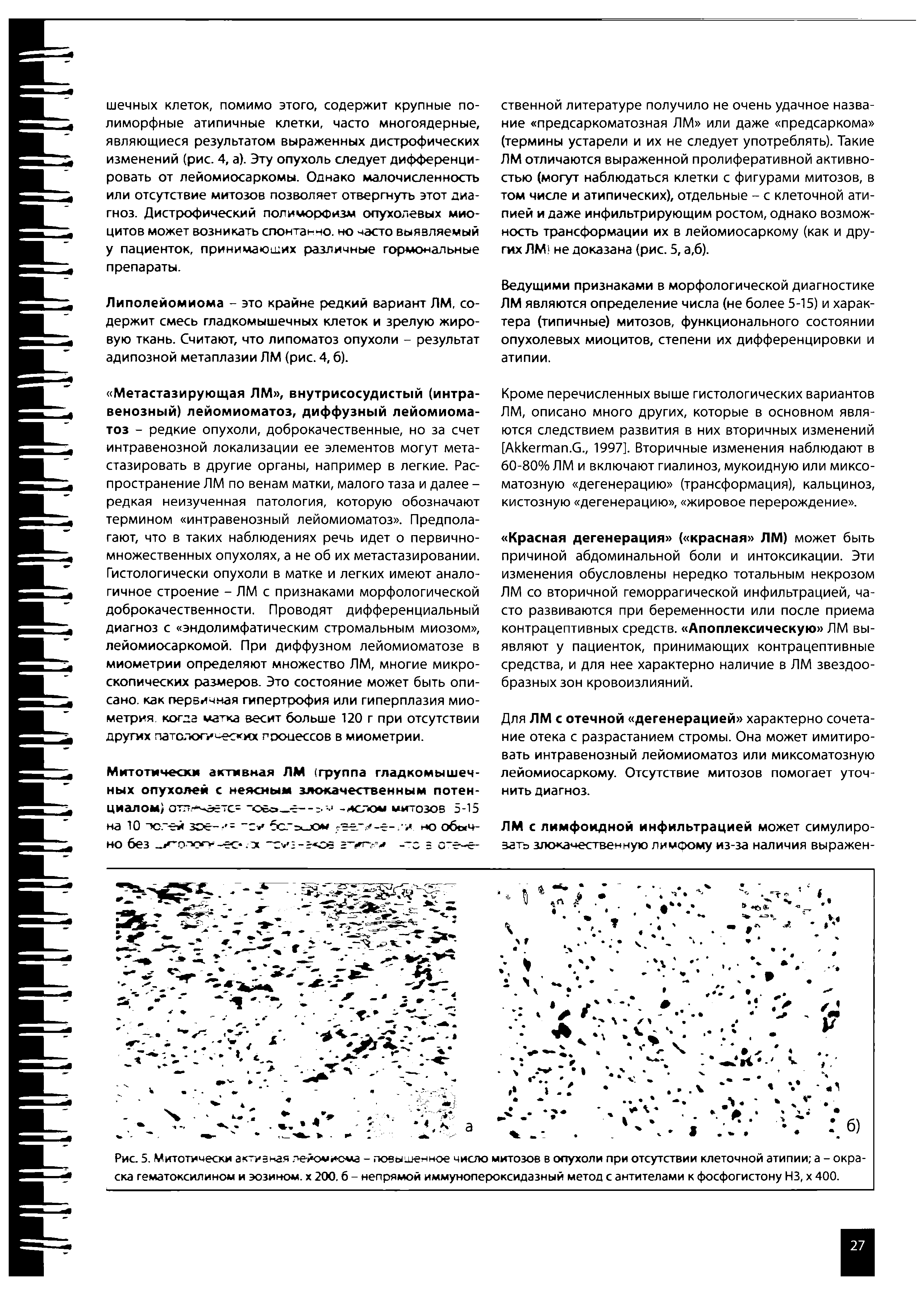 Рис. 5. Митотически активная лейомиома - повышенное число митозов в опухоли при отсутствии клеточной атипии а - окраска гематоксилином и эозином, х 200.6 - непрямой иммунопероксидазный метод с антителами к фосфогистону НЗ, х 400.