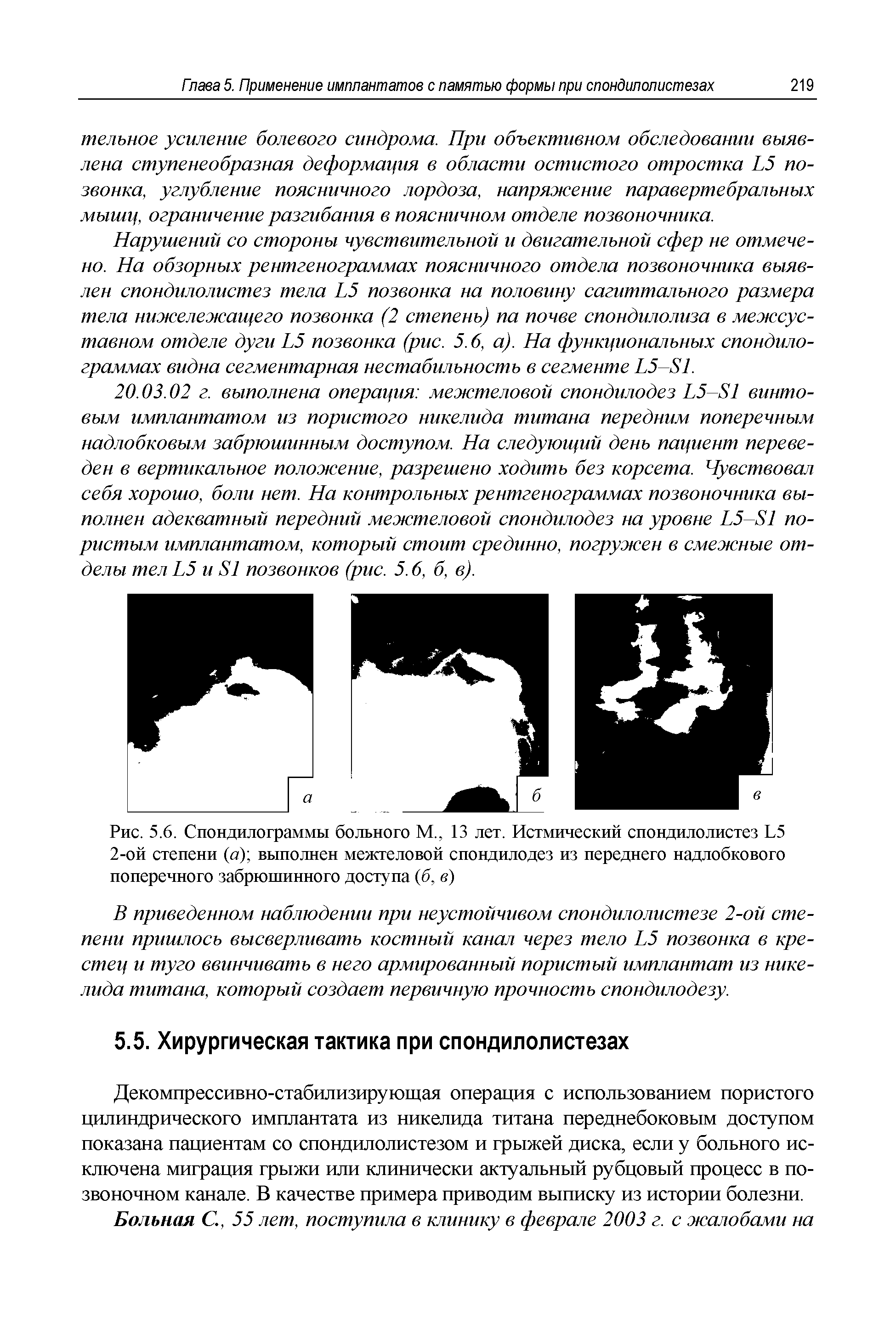 Рис. 5.6. Спондилограммы больного М., 13 лет. Истмический спондилолистез Ь5 2-ой степени (а) выполнен межтеловой спондилодез из переднего надлобкового поперечного забрюшинного доступа (б, в)...