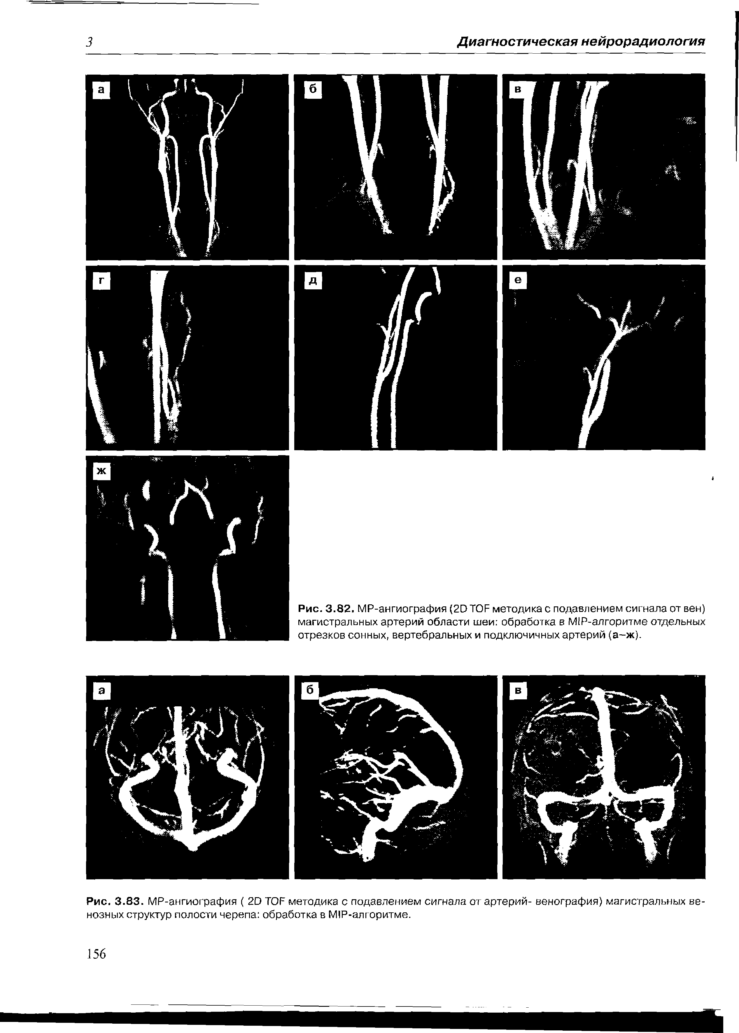 Рис. 3.83. МР-ангиография ( 20 ТОР методика с подавлением сигнала от артерий- венография) магистральных венозных структур полости черепа обработка в М1Р-алгоритме.