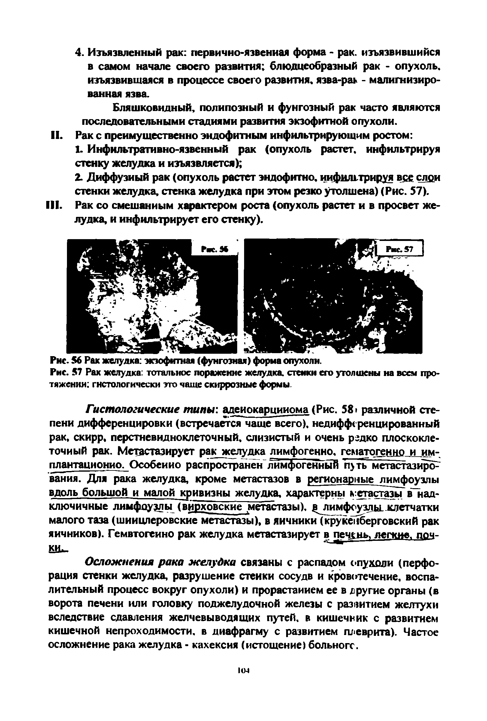 Рис. 57 Рак желудка тотальное поражение желудка, стенки его утолщены на всем протяжении гистологически это чаще скиррозные формы.