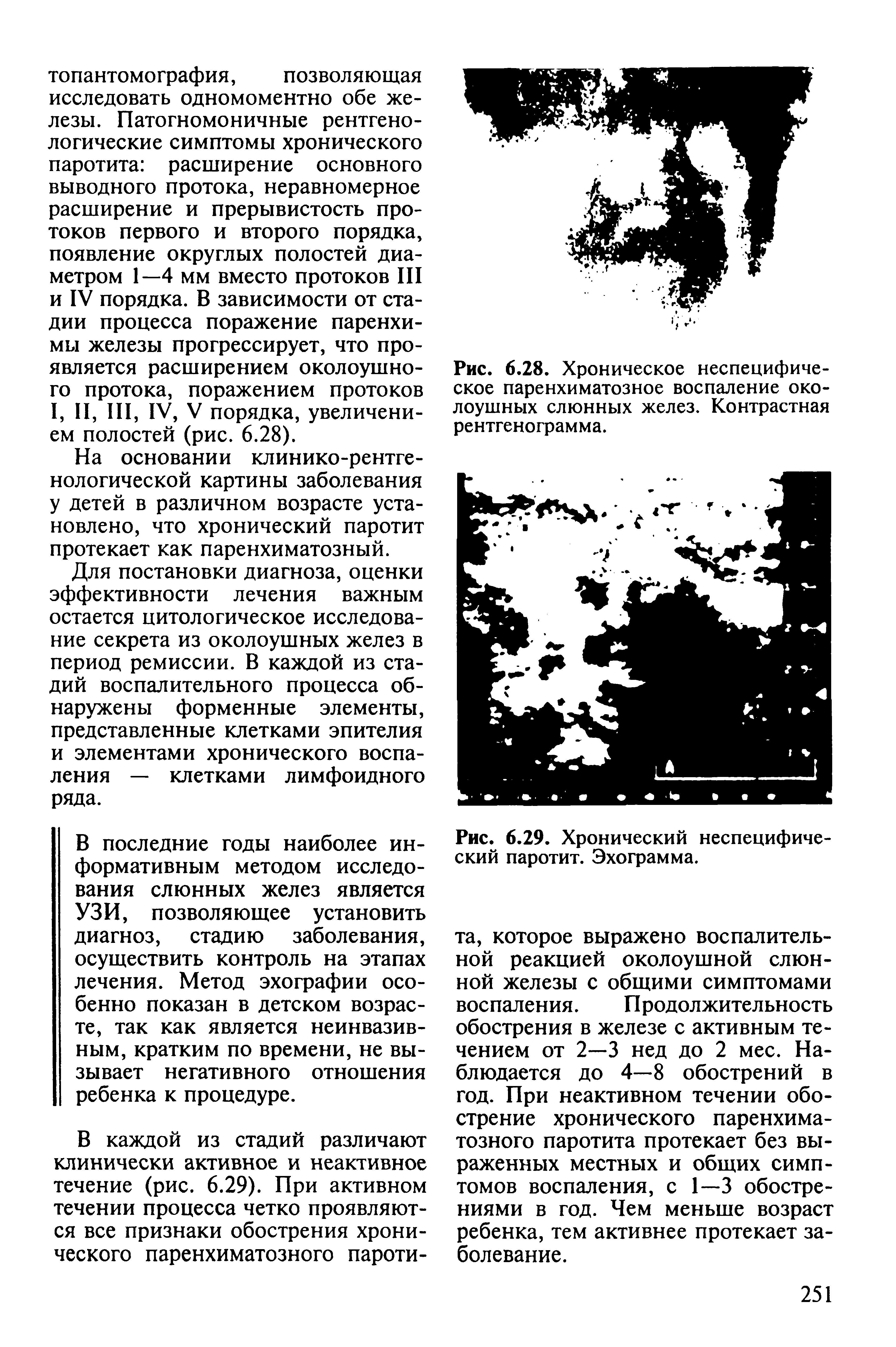 Рис. 6.28. Хроническое неспецифическое паренхиматозное воспаление околоушных слюнных желез. Контрастная рентгенограмма.