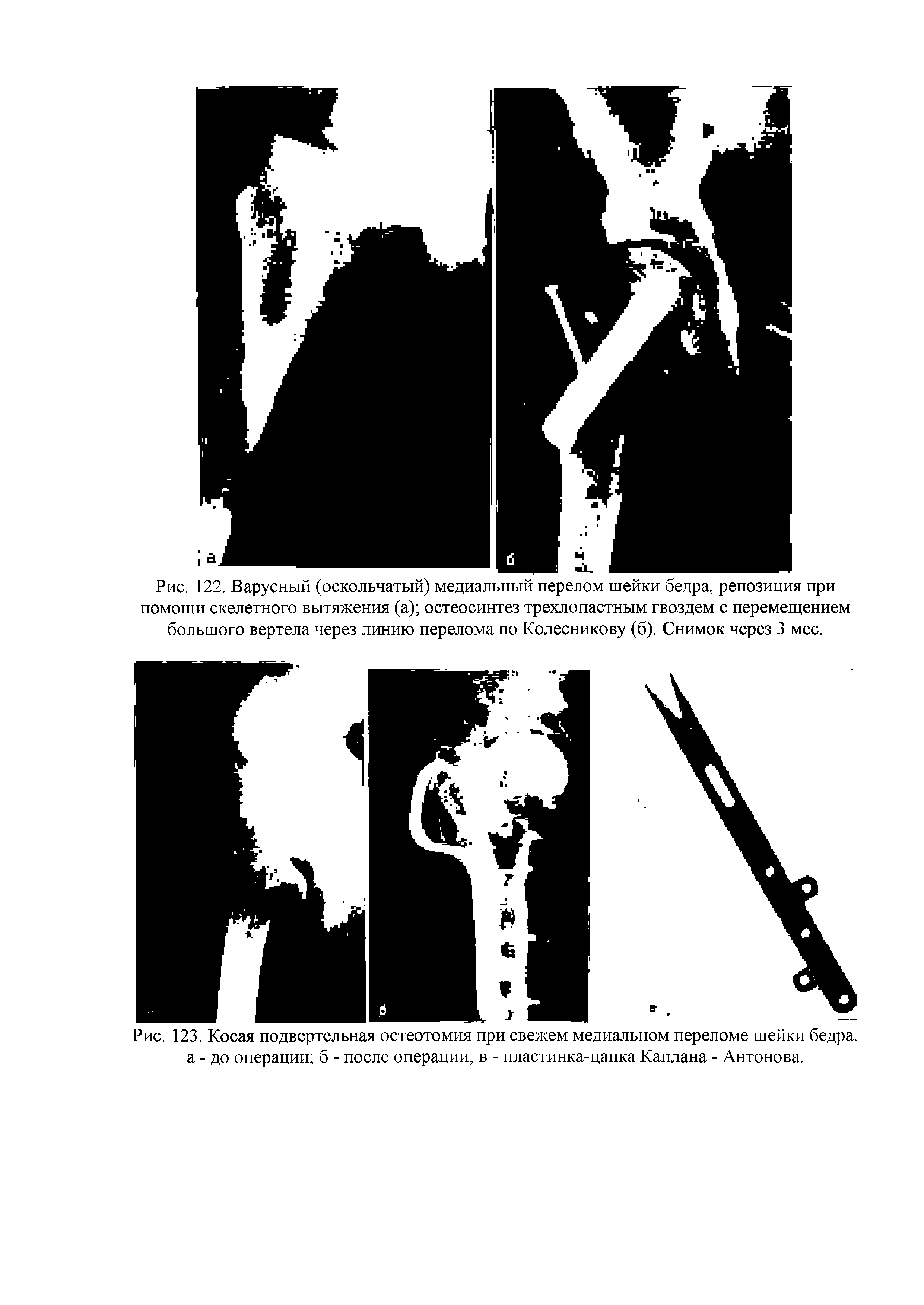 Рис. 122. Варусный (оскольчатый) медиальный перелом шейки бедра, репозиция при помощи скелетного вытяжения (а) остеосинтез трехлопастным гвоздем с перемещением большого вертела через линию перелома по Колесникову (б). Снимок через 3 мес.