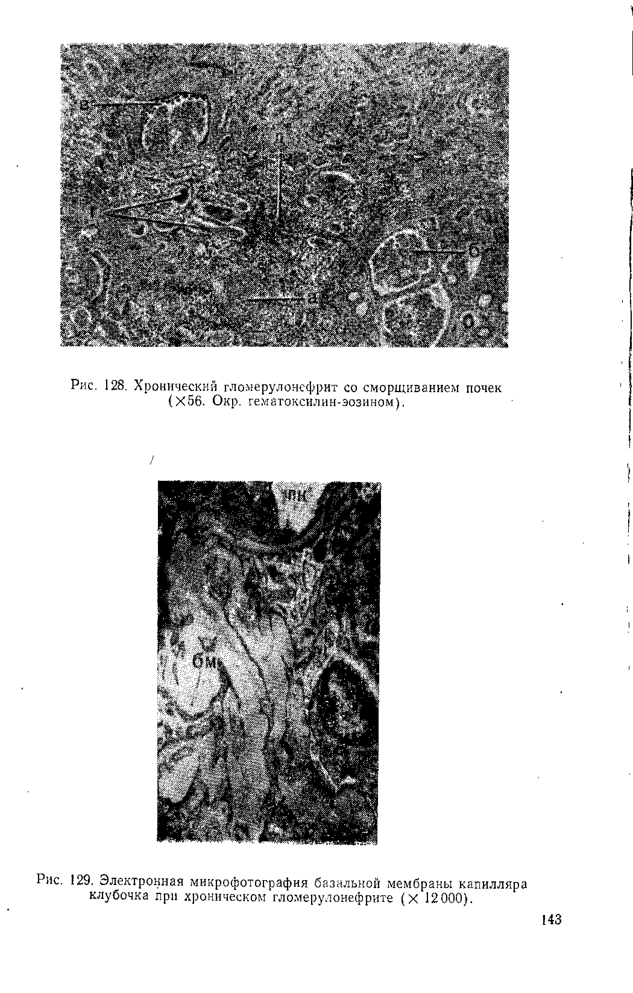 Рис. 129. Электронная микрофотография базальной мембраны капилляра клубочка при хроническом гломерулонефрите (X 12000).