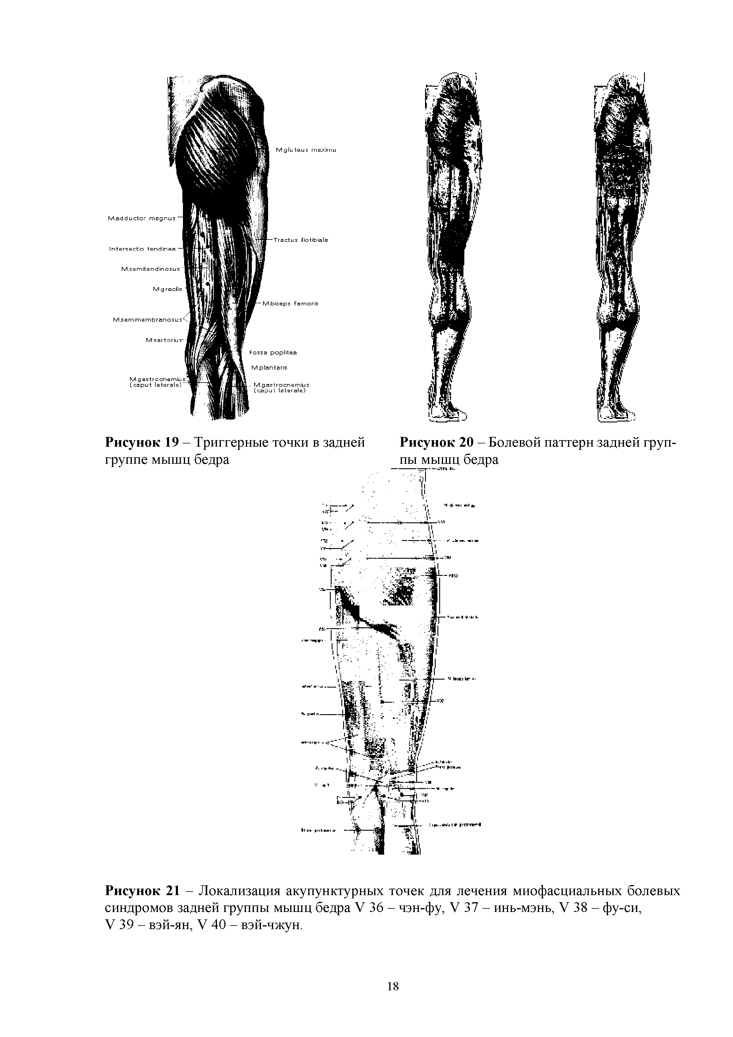 Рисунок 21 - Локализация акупунктурных точек для лечения миофасциальных болевых синдромов задней группы мышц бедра V 36 - чэн-фу, V 37 - инь-мэнь, V 38 - фу-си, V 39 - вэй-ян, V 40 - вэй-чжун.