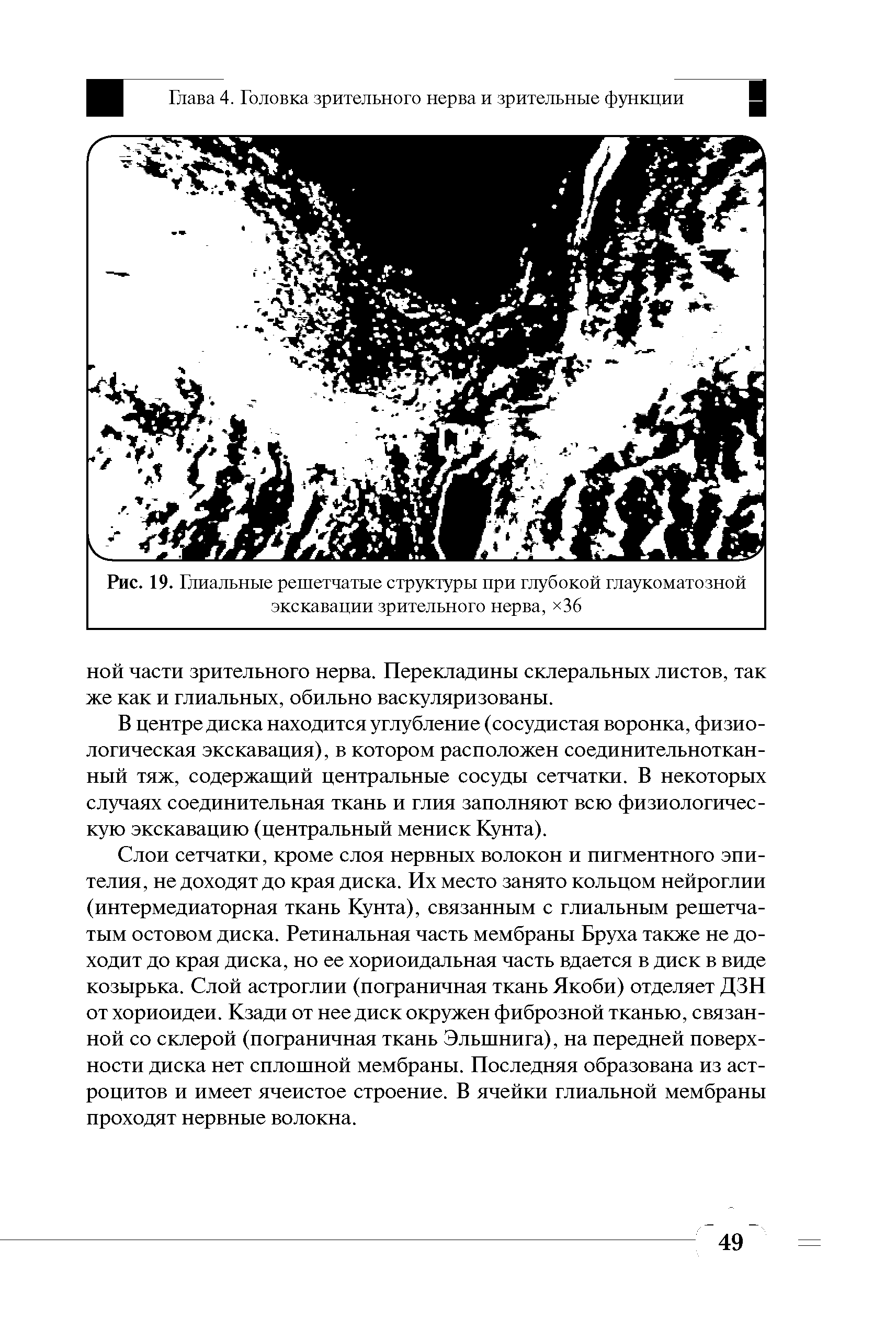 Рис. 19. Глиальные решетчатые структуры при глубокой глаукоматозной экскавации зрительного нерва, 36...