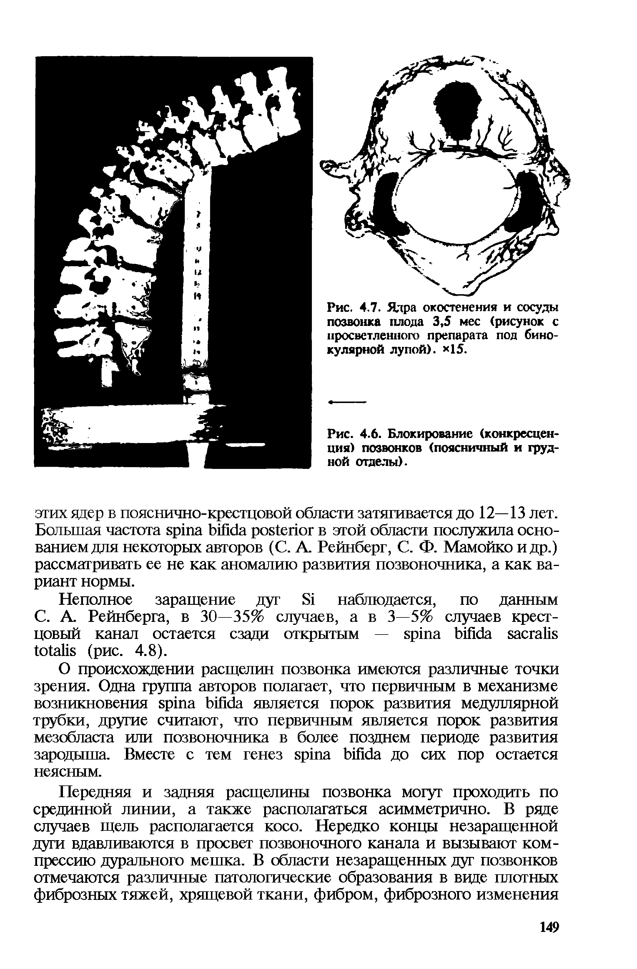 Рис. 4.6. Блокирование (конкресцен-ция) позвонков (поясничный и грудной отделы).