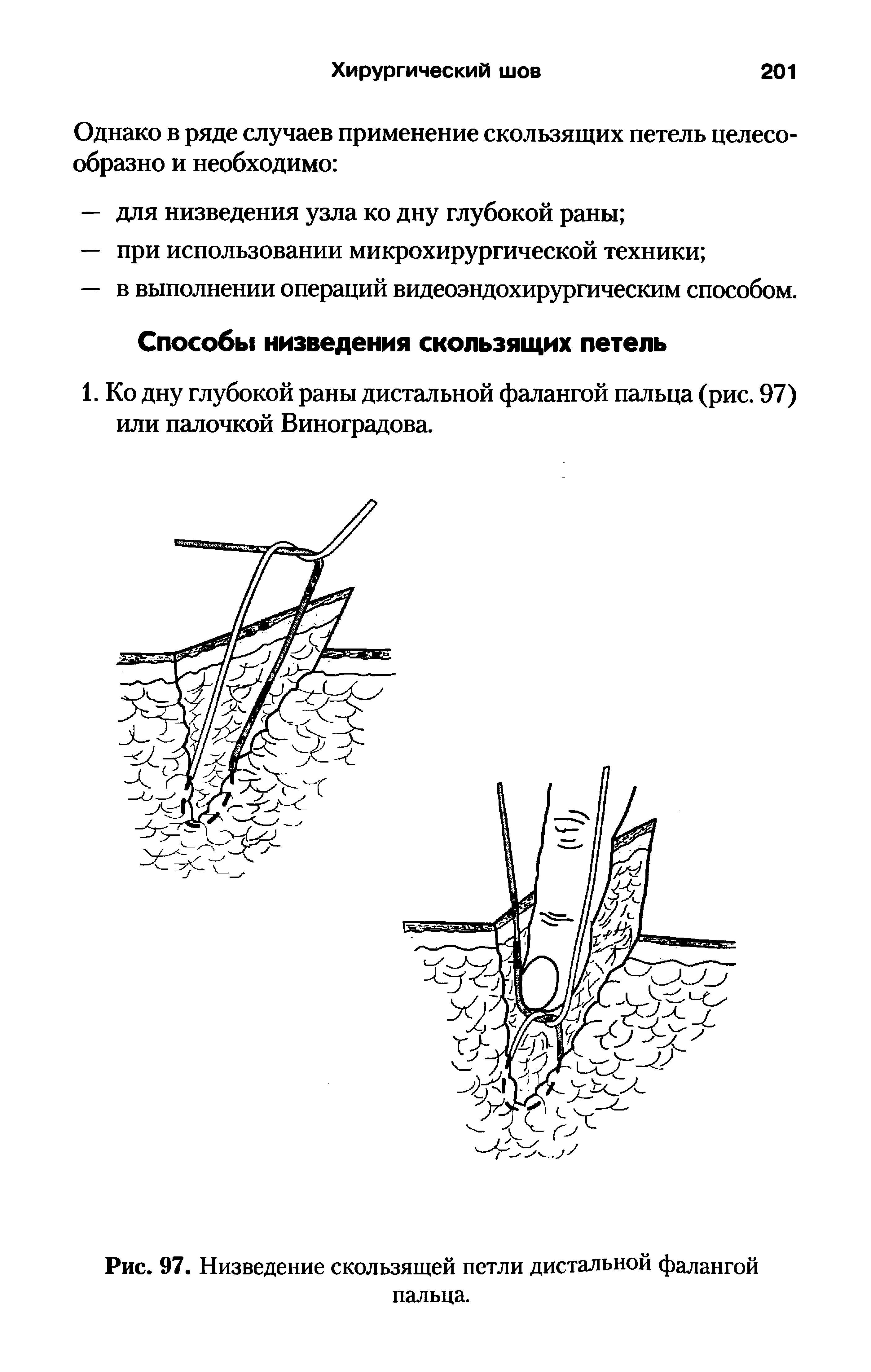 Рис. 97. Низведение скользящей петли дистальной фалангой пальца.