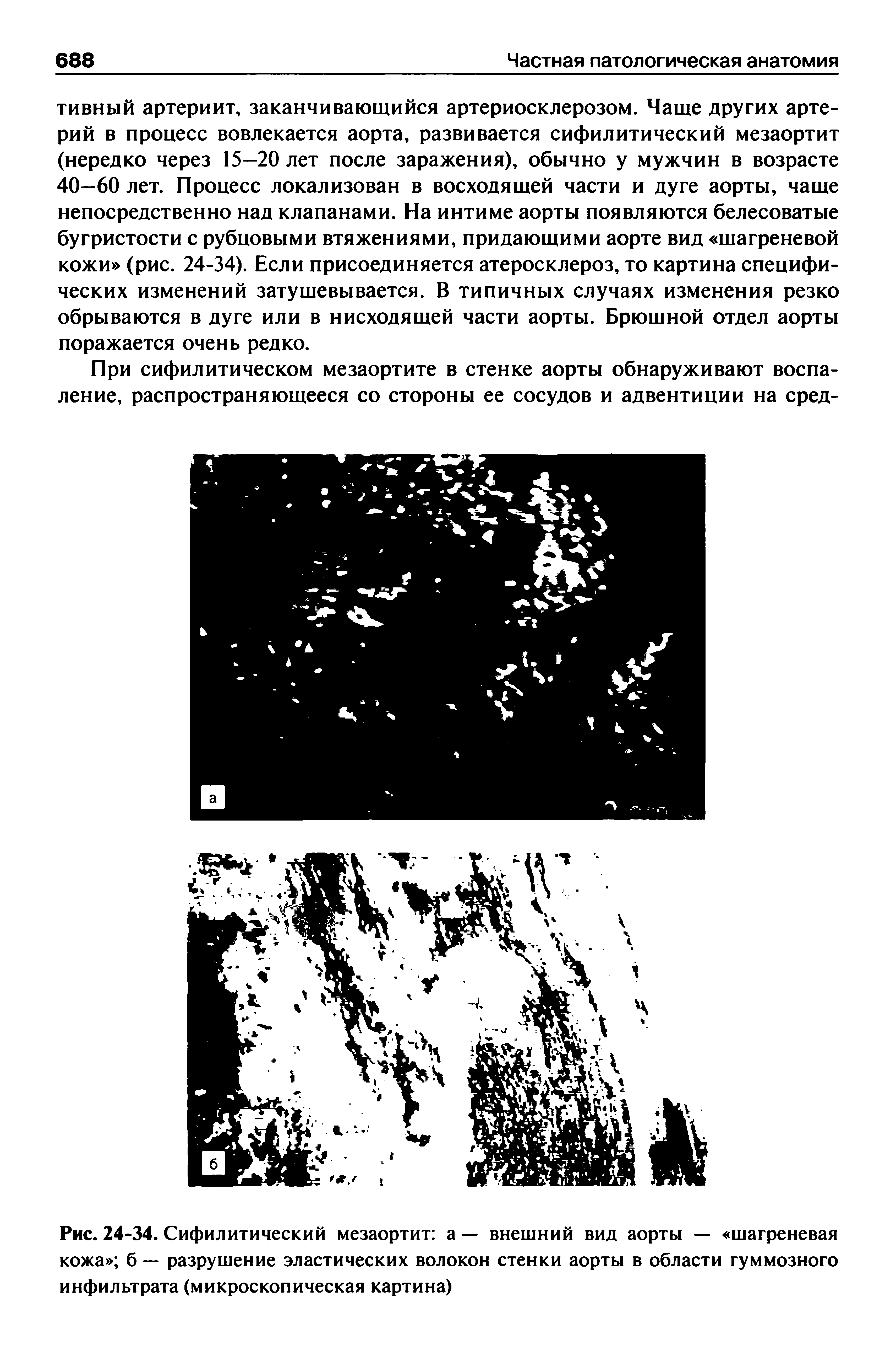 Рис. 24-34. Сифилитический мезаортит а — внешний вид аорты — шагреневая кожа б — разрушение эластических волокон стенки аорты в области гуммозного инфильтрата (микроскопическая картина)...