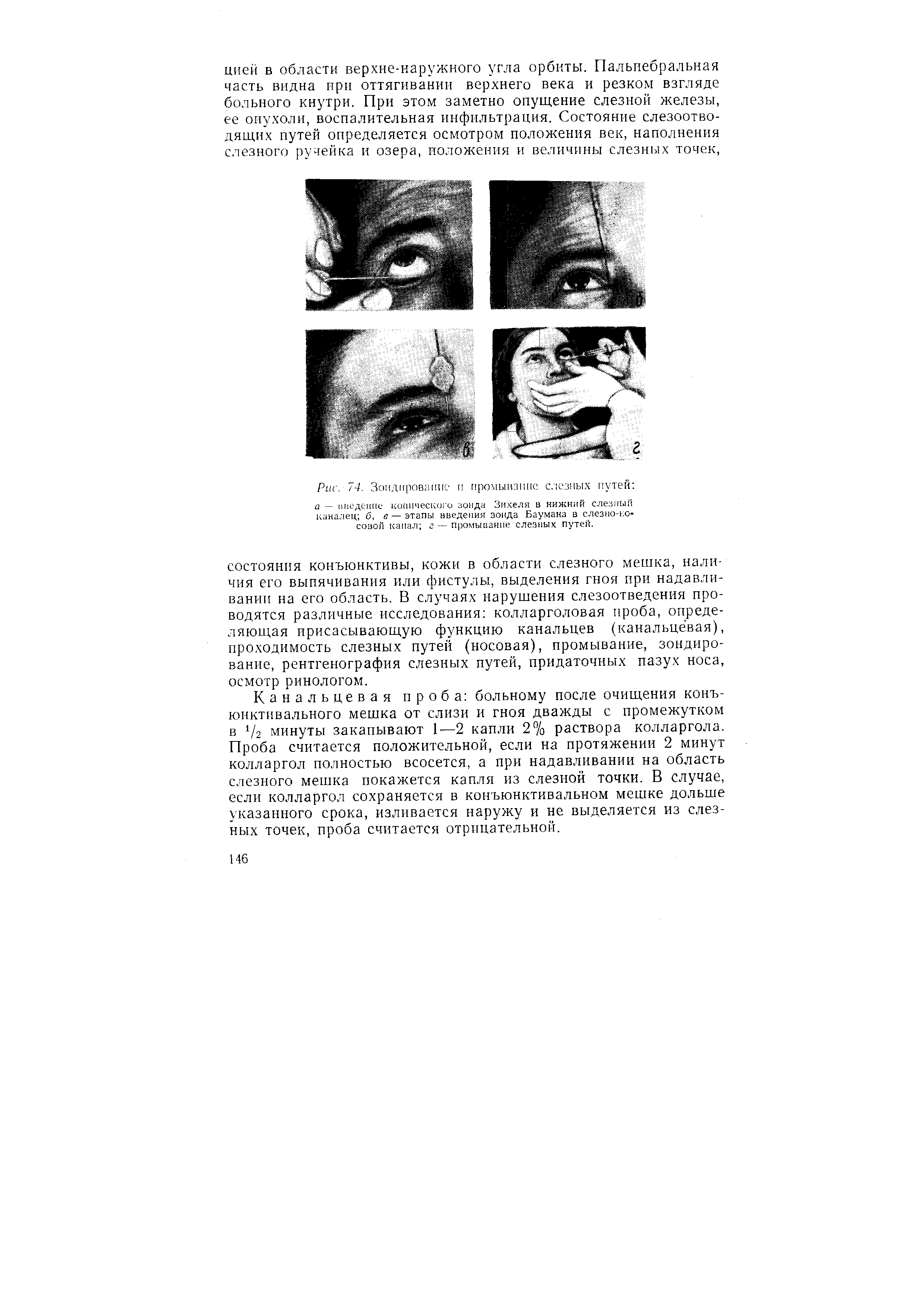 Рис. /4. Зондирование н промывание слезных путей а — введение конического зонда Зихеля в нижний слезный каналец б, е — этапы введения зонда Баумана в слезно-носовой канал г — промывание слезных путей.
