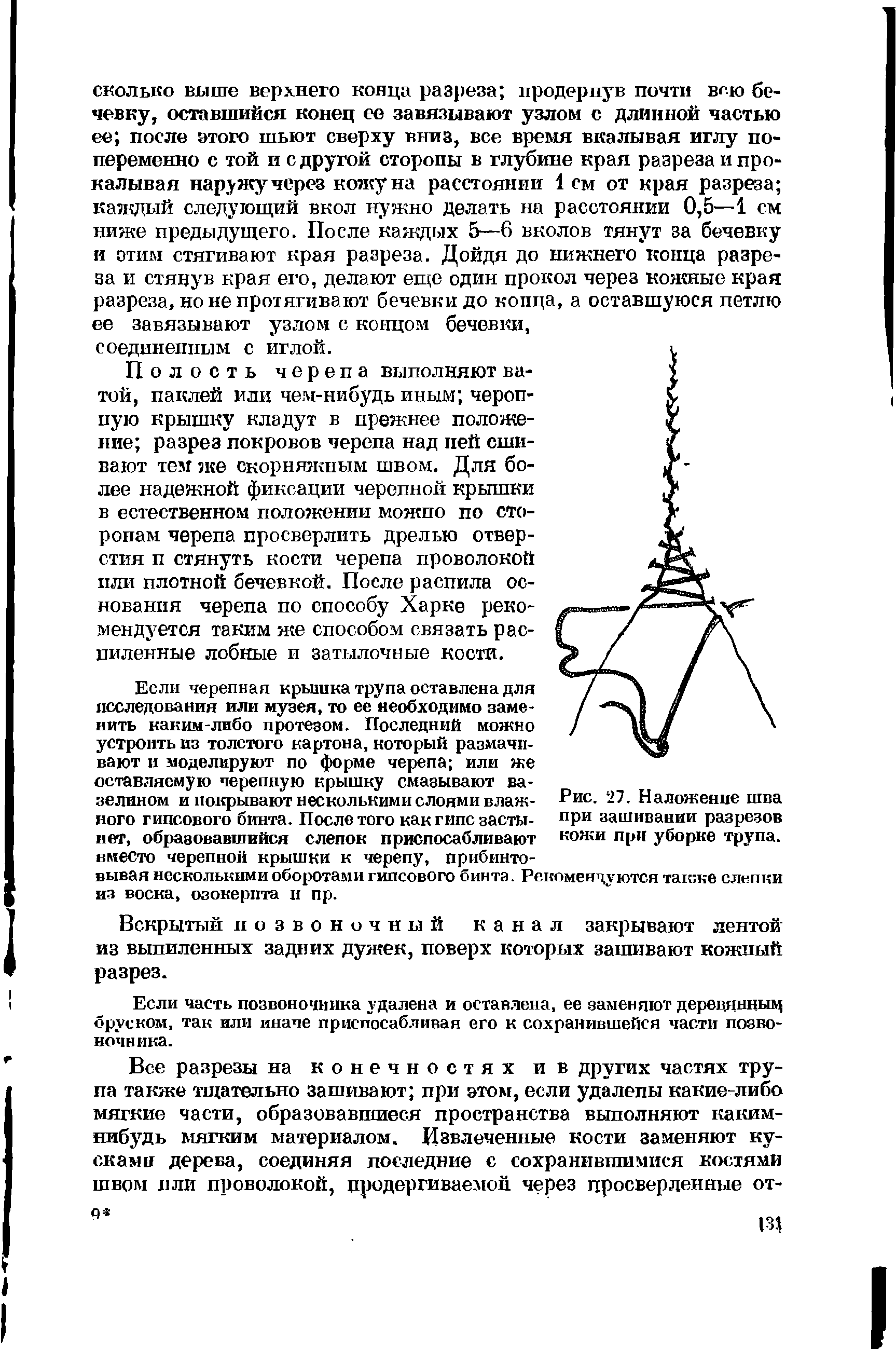 Рис. 27. Наложение шва при зашивании разрезов кожи при уборке трупа.