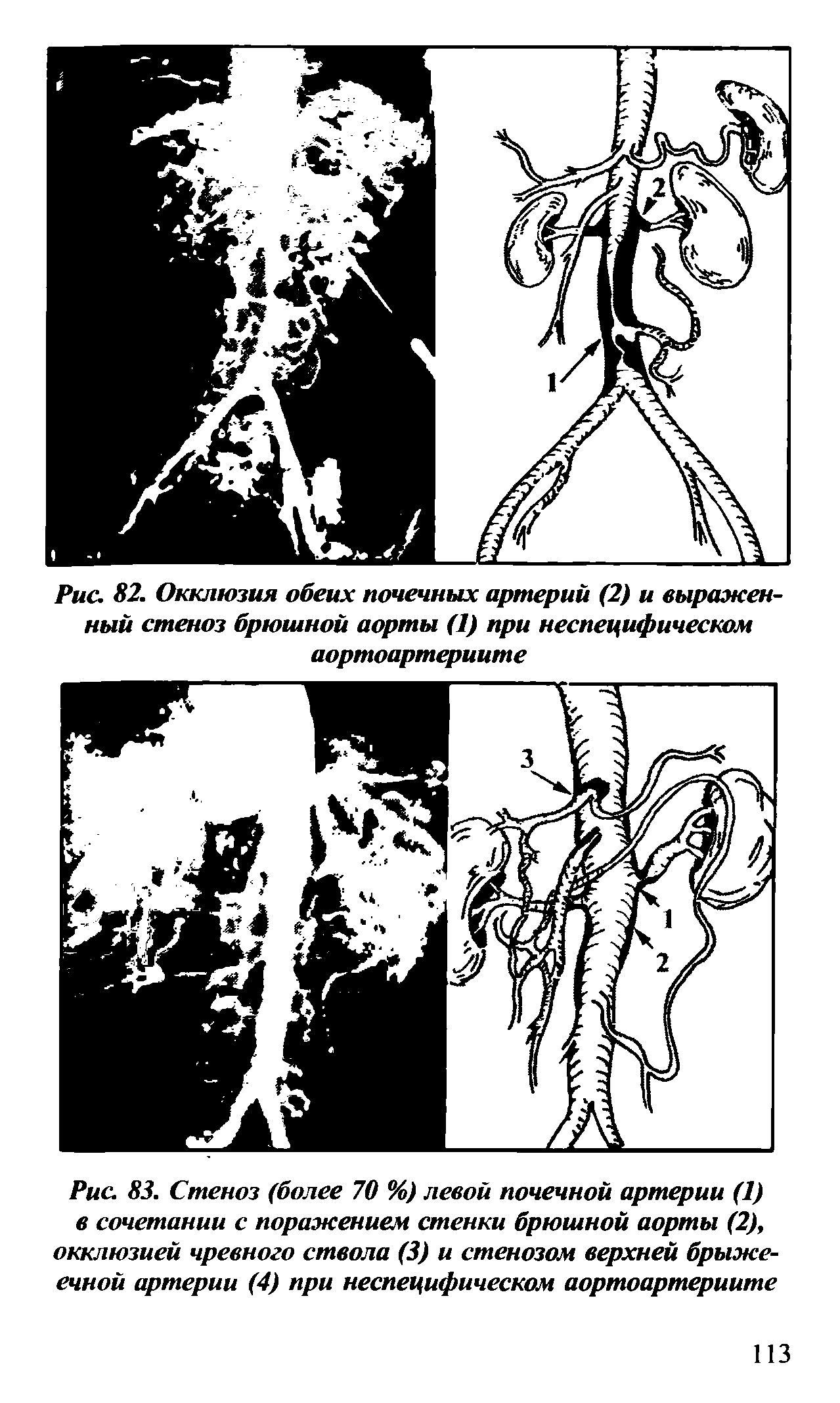 Рис. 83. Стеноз (более 70 %) левой почечной артерии (1) в сочетании с поражением стенки брюшной аорты (2), окклюзией чревного ствола (3) и стенозом верхней брыжеечной артерии (4) при неспецифическом аортоартериите...