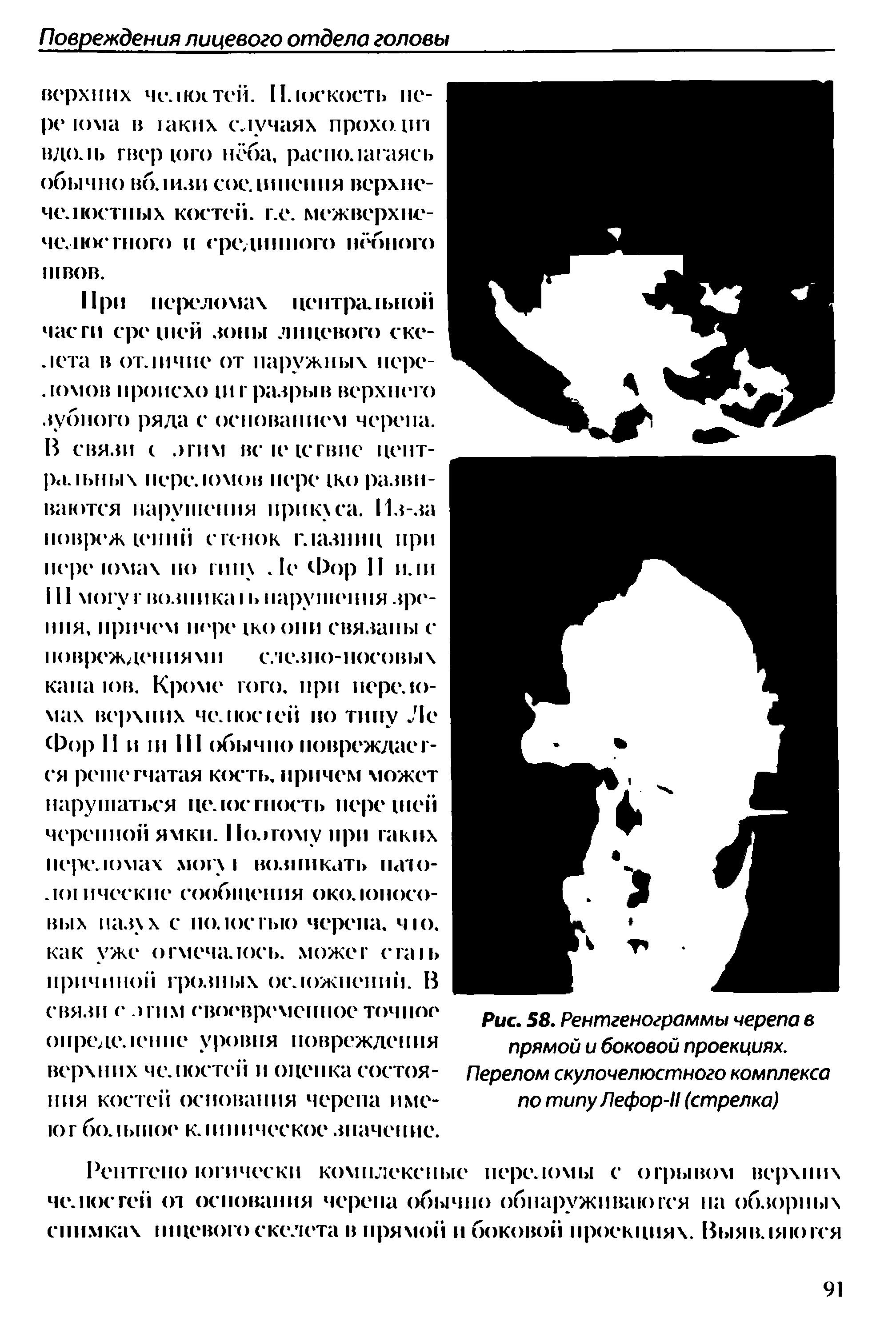 Рис. 58. Рентгенограммы черепа в прямой и боковой проекциях. Перелом скулочелюстного комплекса по типу Лефор-11 (стрелка)...