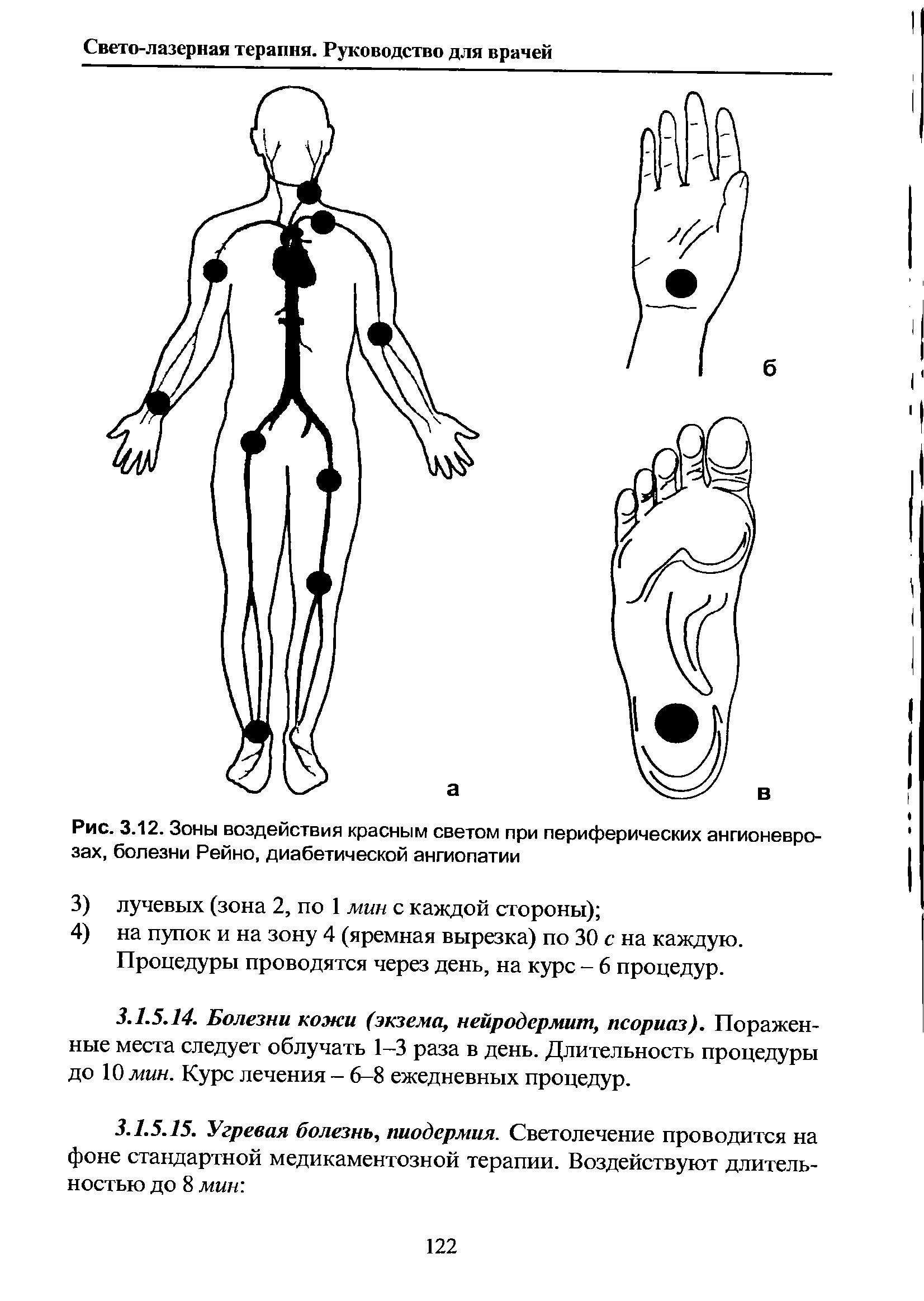 Рис. 3.12. Зоны воздействия красным светом при периферических ангионеврозах, болезни Рейно, диабетической ангиопатии...