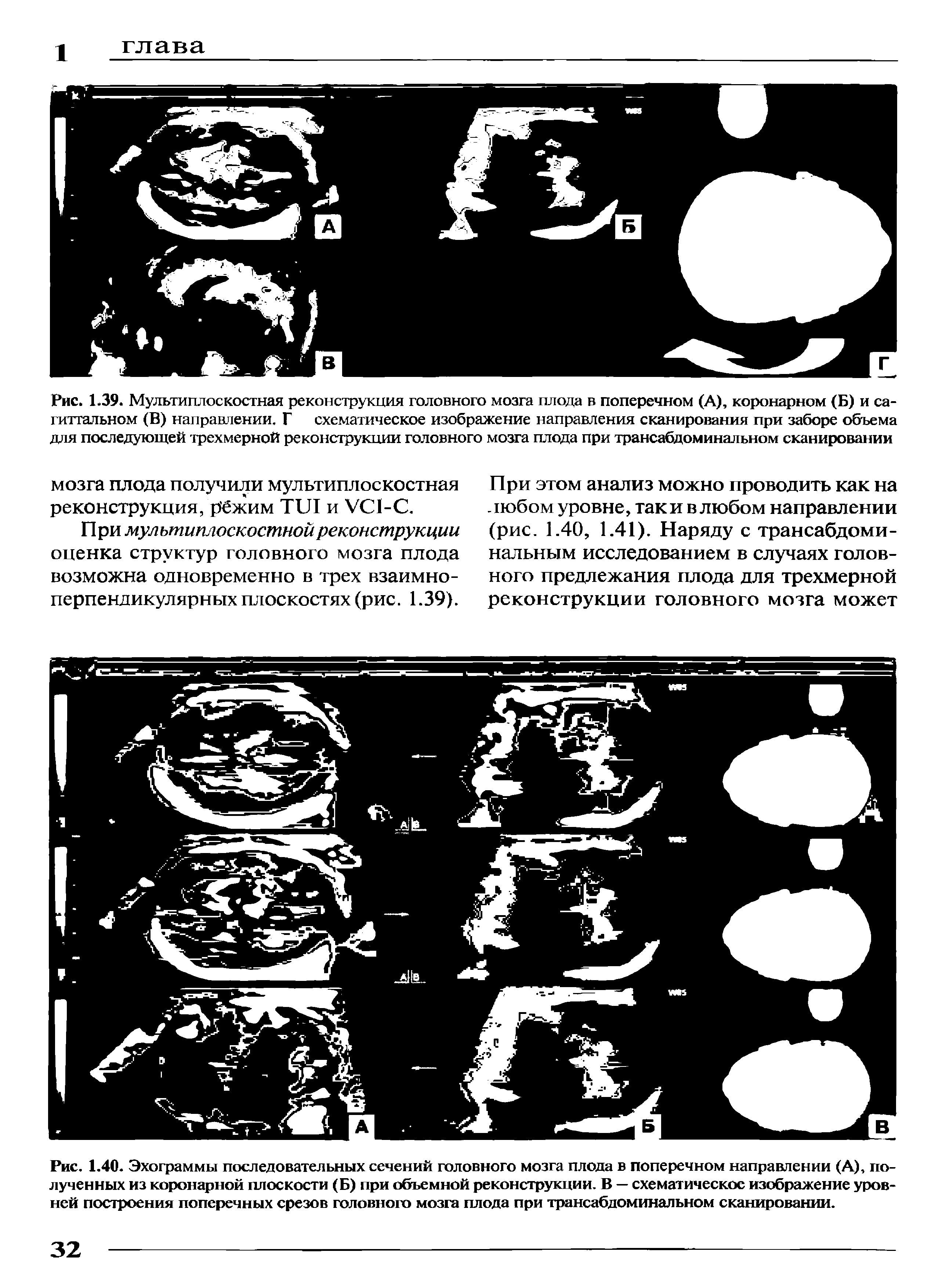Рис. 1.39. Мультиплоскостная реконструкция головного мозга плода в поперечном (А), коронарном (Б) и сагиттальном (В) направлении. Г схематическое изображение направления сканирования при заборе объема для последующей трехмерной реконструкции головного мозга плода при трансабдоминальном сканировании...
