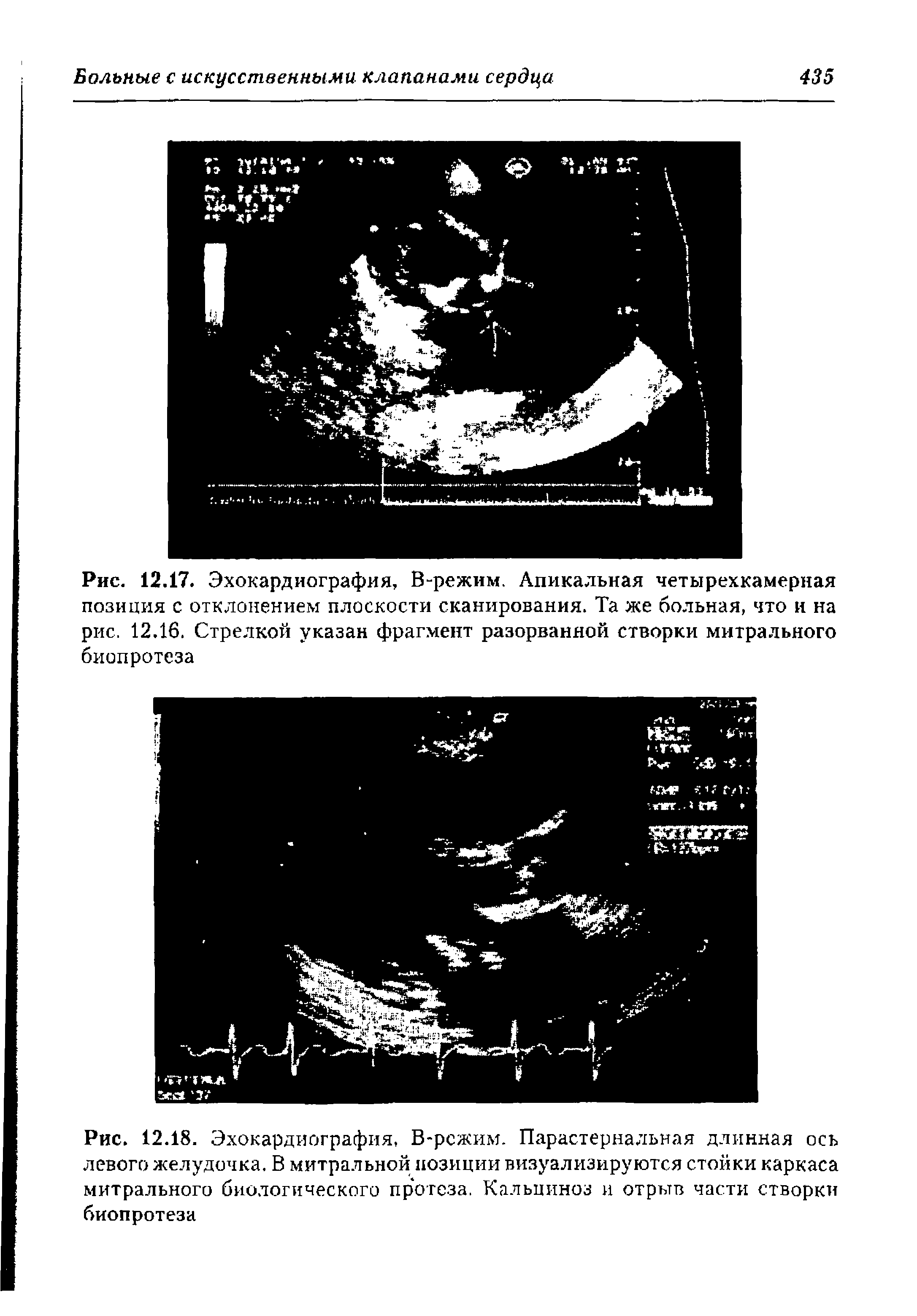 Рис. 12.18. Эхокардиография, В-рсжим. Парастернальная длинная ось левого желудочка. В митральной позиции визуализируются стойки каркаса митрального биологического протеза. Кальциноз и отрыв части створки биопротеза...