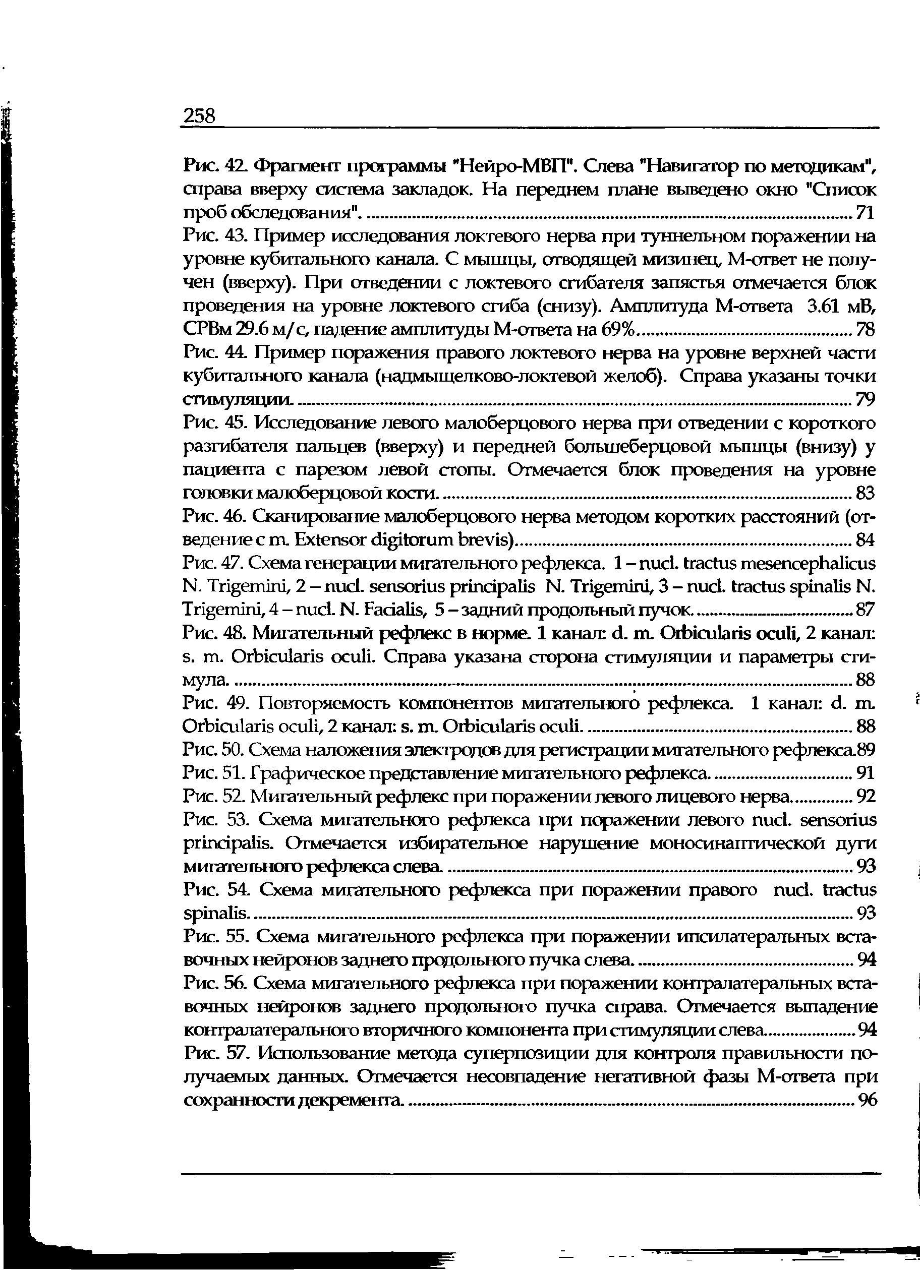 Рис. 45. Исследование левого малоберцового нерва при отведении с короткого разгибателя пальцев (вверху) и передней большеберцовой мышцы (внизу) у пациента с парезом левой стопы. Отмечается блок проведения на уровне головки малоберцовой кости.83...