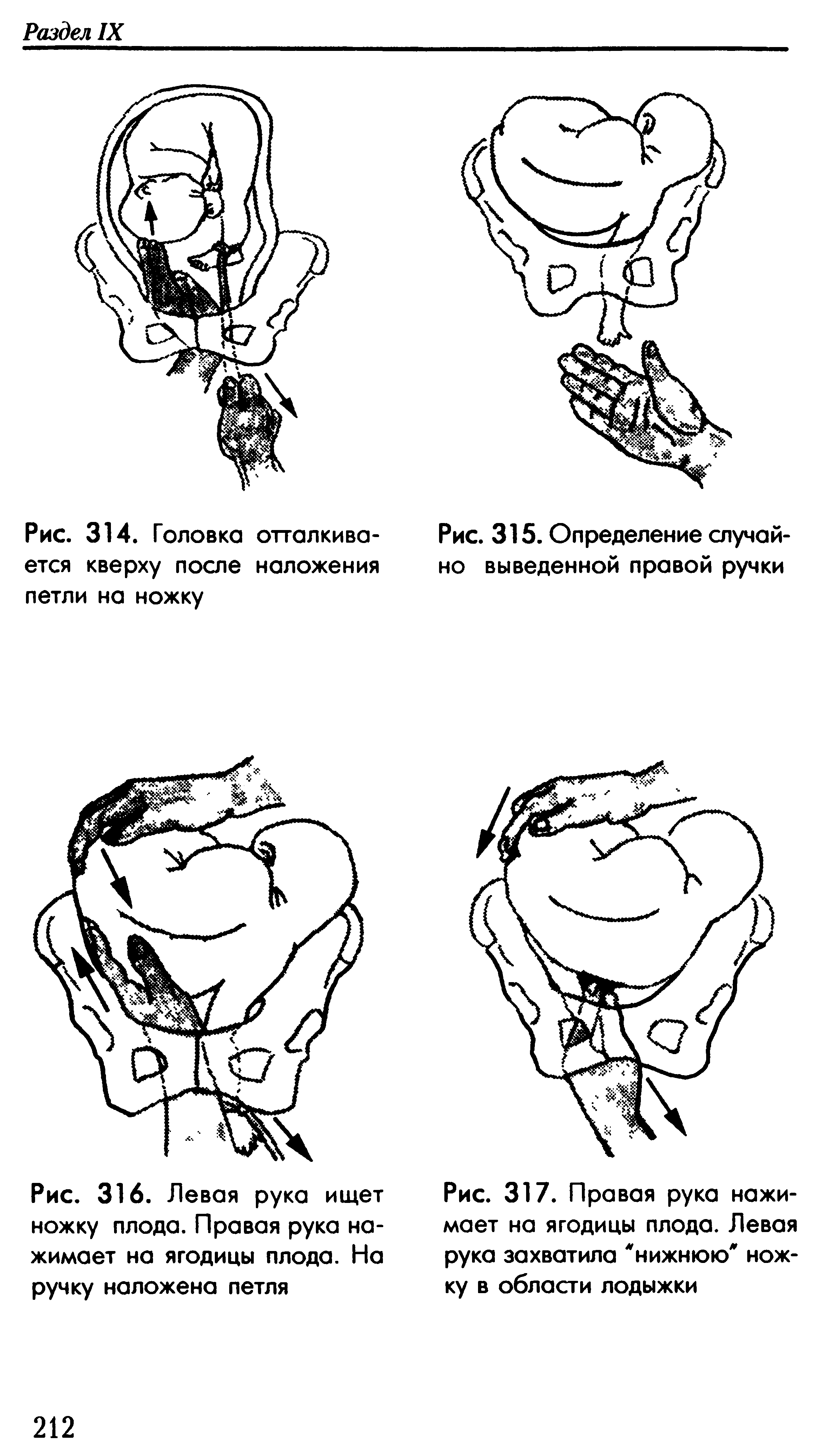 Рис. 316. Левая рука ищет ножку плода. Правая рука нажимает на ягодицы плода. На ручку наложена петля...