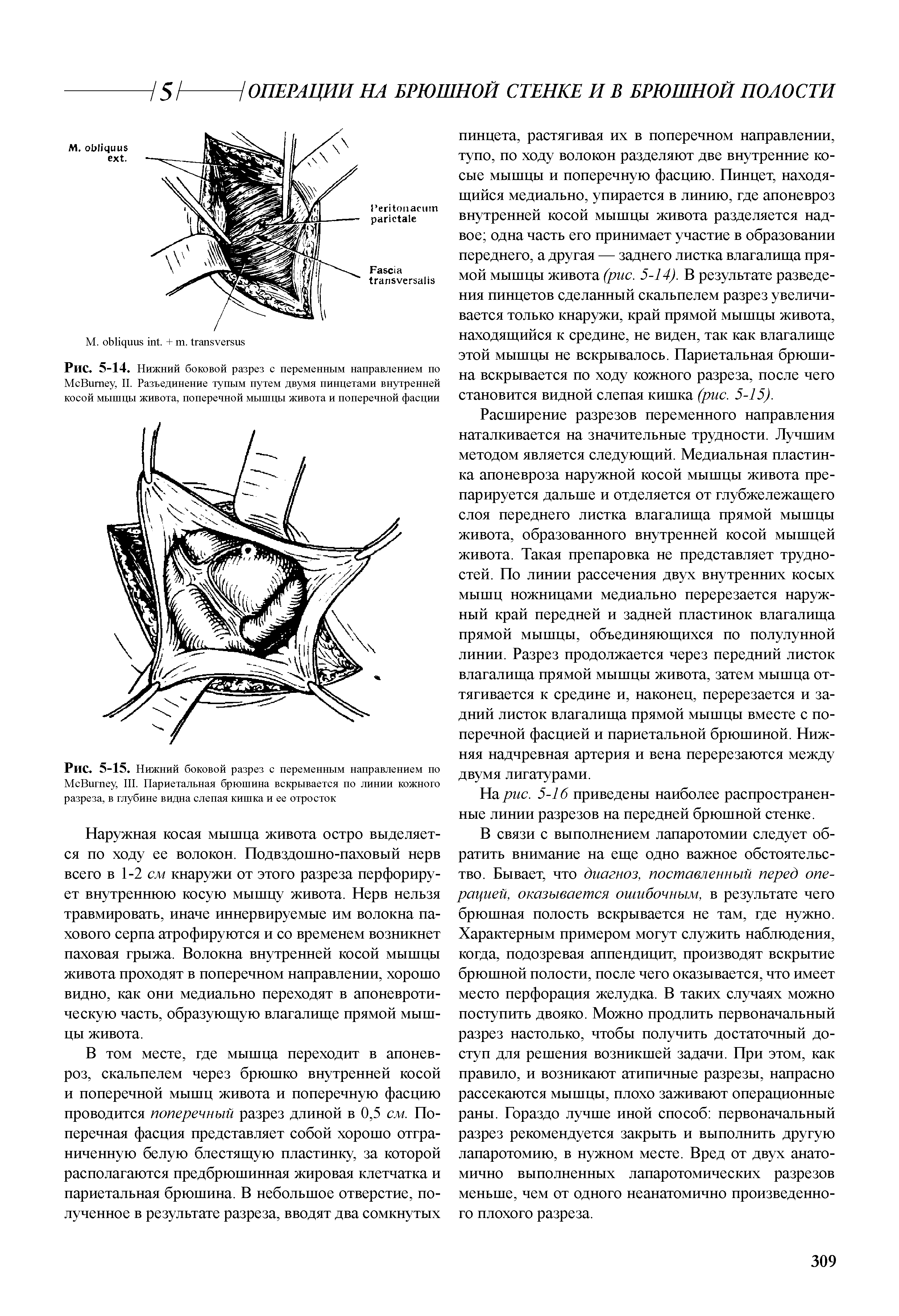 Рис. 5-14. Нижний боковой разрез с переменным направлением по M B , II. Разъединение тупым путем двумя пинцетами внутренней косой мышцы живота, поперечной мышцы живота и поперечной фасции...