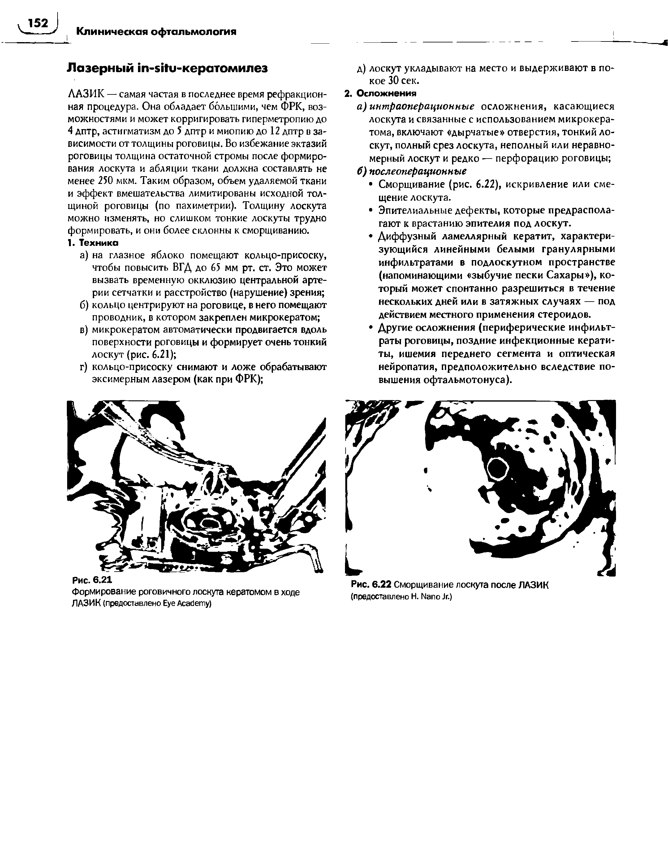 Рис. 6.22 Сморщивание лоскута после ЛАЗИК (предоставлено Н. N J .)...