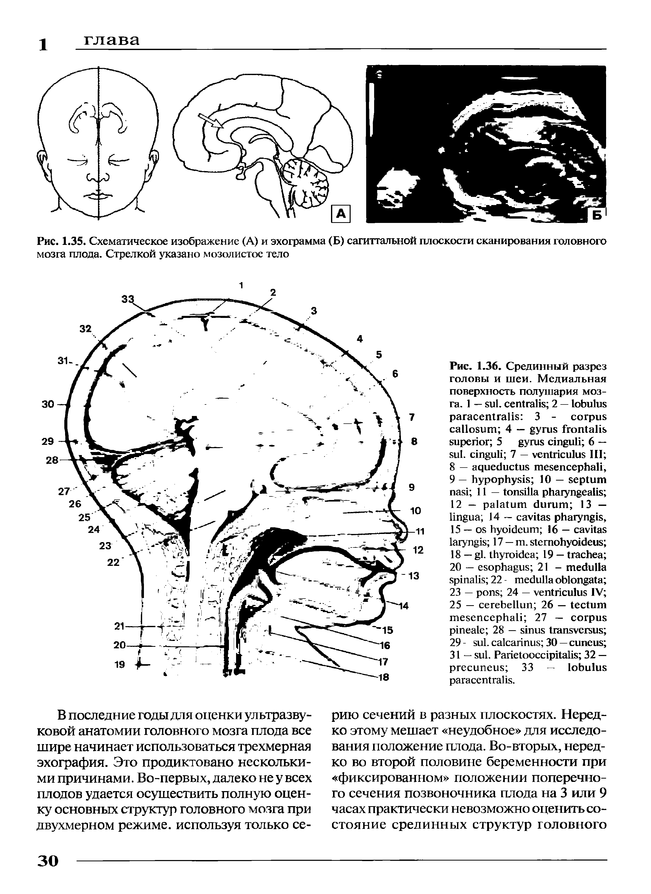Рис. 1.35. Схематическое изображение (А) и эхограмма (Б) сагиттальной плоскости сканирования головного мозга плода. Стрелкой указано мозолистое тело...