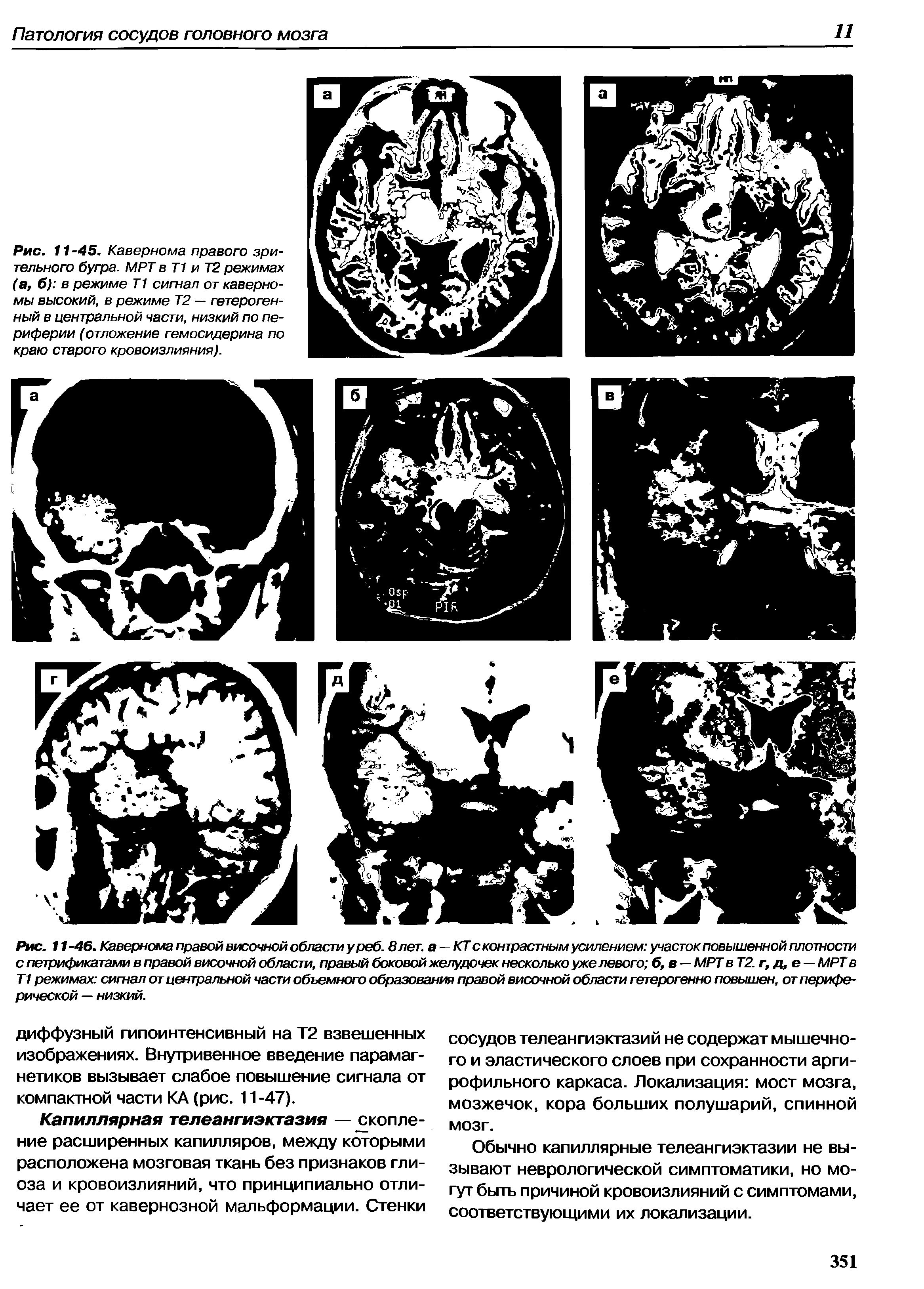 Рис. 11-46. Кавернома правой височной области у реб. 8 лет. а — КТ с контрастным усилением участок повышенной плотности с петрификатами в правой височной области, правый боковой желудочек несколько уже левого б, в — МРТ в Т2. г,д,е МРТ в Т1 режимах сигнал от центральной части объемного образования правой височной области гетерогенно повышен, от периферической — низкий.