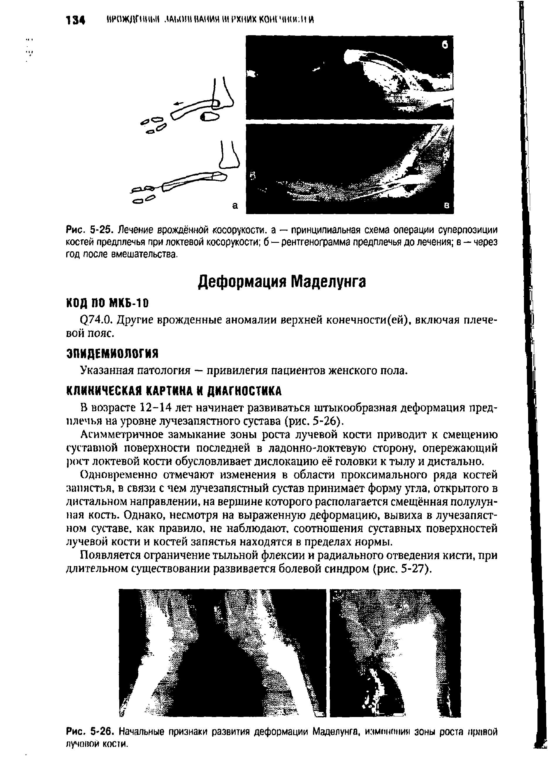 Рис. 5-25. Лечение врождённой косорукости, а — принципиальная схема операции суперпозиции костей предплечья при локтевой косорукости б — рентгенограмма предплечья до лечения в — через год после вмешательства.