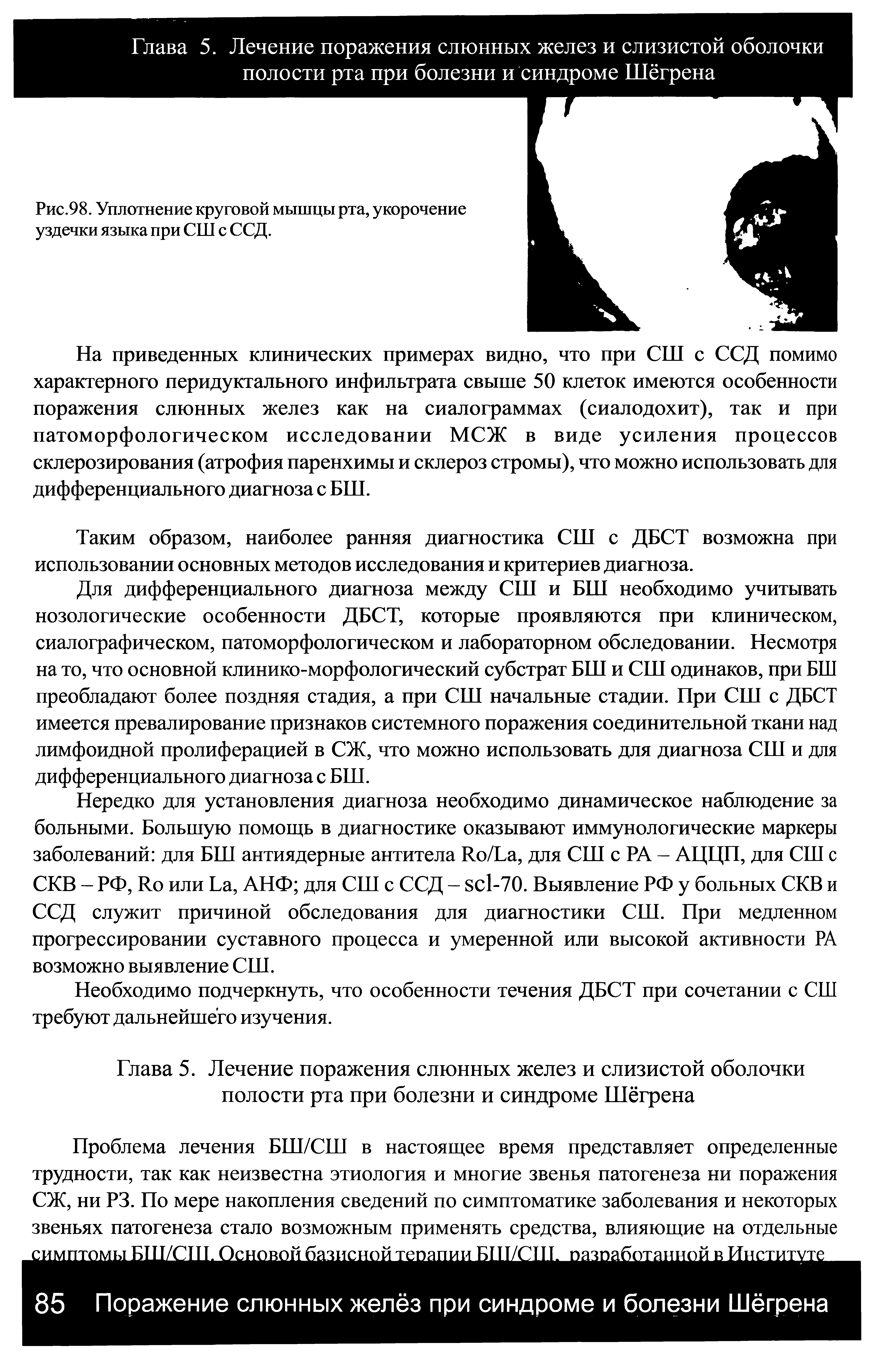 Рис.98. Уплотнение круговой мышцы рта, укорочение уздечки языка при СШ с ССД.