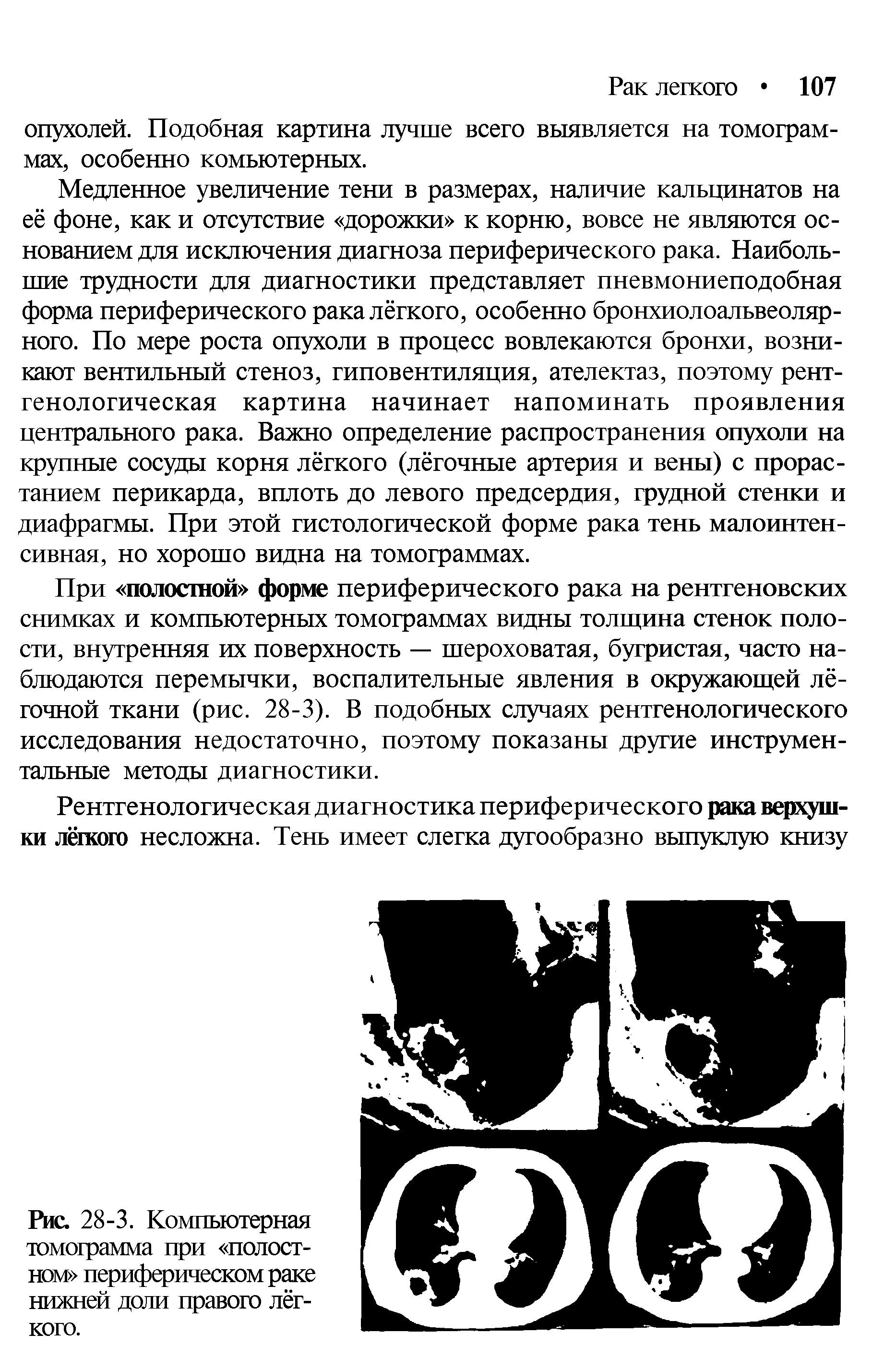 Рис. 28-3. Компьютерная томограмма при полостном периферическом раке нижней доли правого лёгкого.