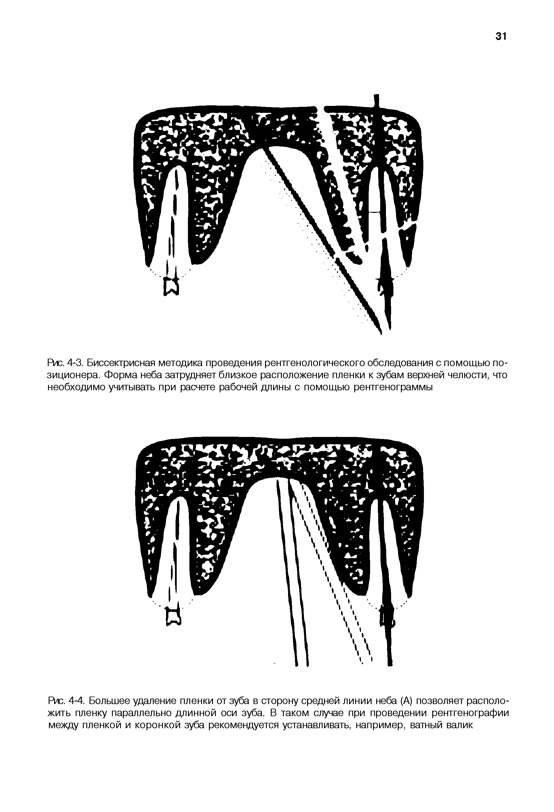 Рис. 4-4. Большее удаление пленки от зуба в сторону средней линии неба (А) позволяет расположить пленку параллельно длинной оси зуба. В таком случае при проведении рентгенографии между пленкой и коронкой зуба рекомендуется устанавливать, например, ватный валик...