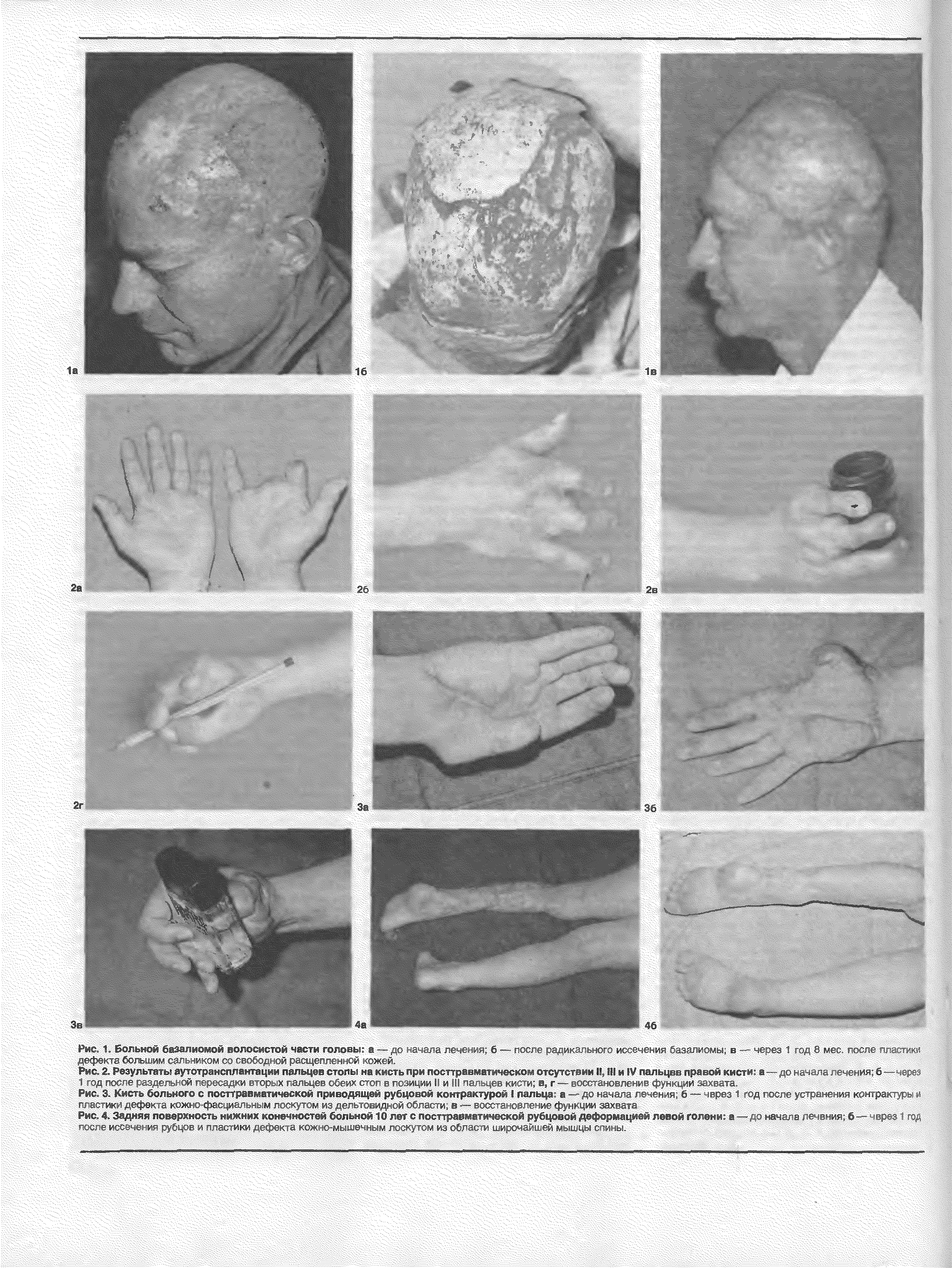 Рис. 2. Результаты аутотрансплантации пальцев стопы на кисть при посттравматическом отсутствии II, III и IV пальцев правой кисти а - до начгпа лечения, б — - д-.. 1 -од п <> рг д чм ой гтргддгди еморих пальцев ст <г с петиции III и нгдыдн ки ш в, г —е-хс шелеы-д ф/нкьми м-г.ата...