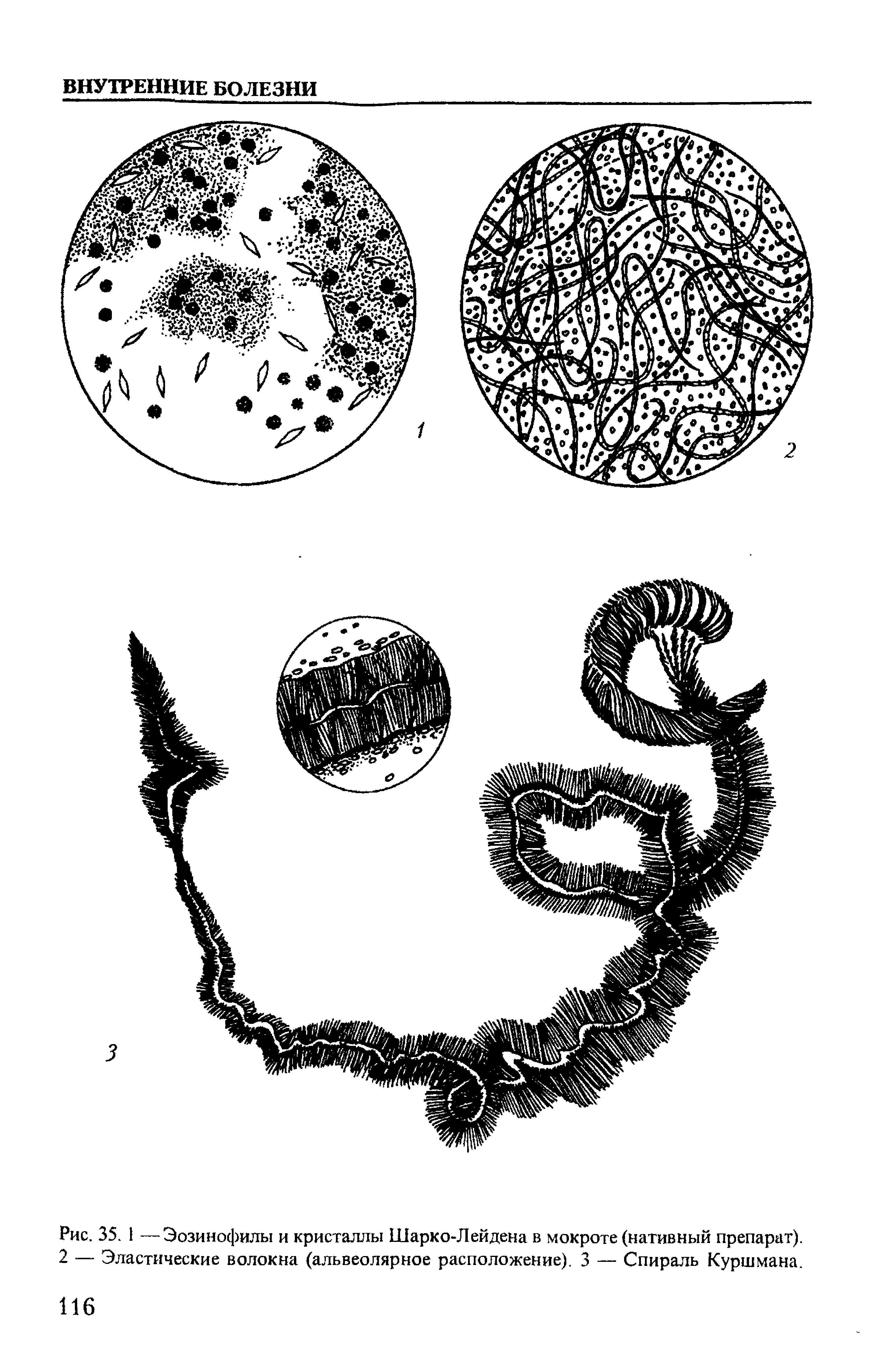 Рис. 35. 1 —Эозинофилы и кристаллы Шарко-Лейдена в мокроте (нативный препарат). 2 — Эластические волокна (альвеолярное расположение). 3 — Спираль Куршмана.