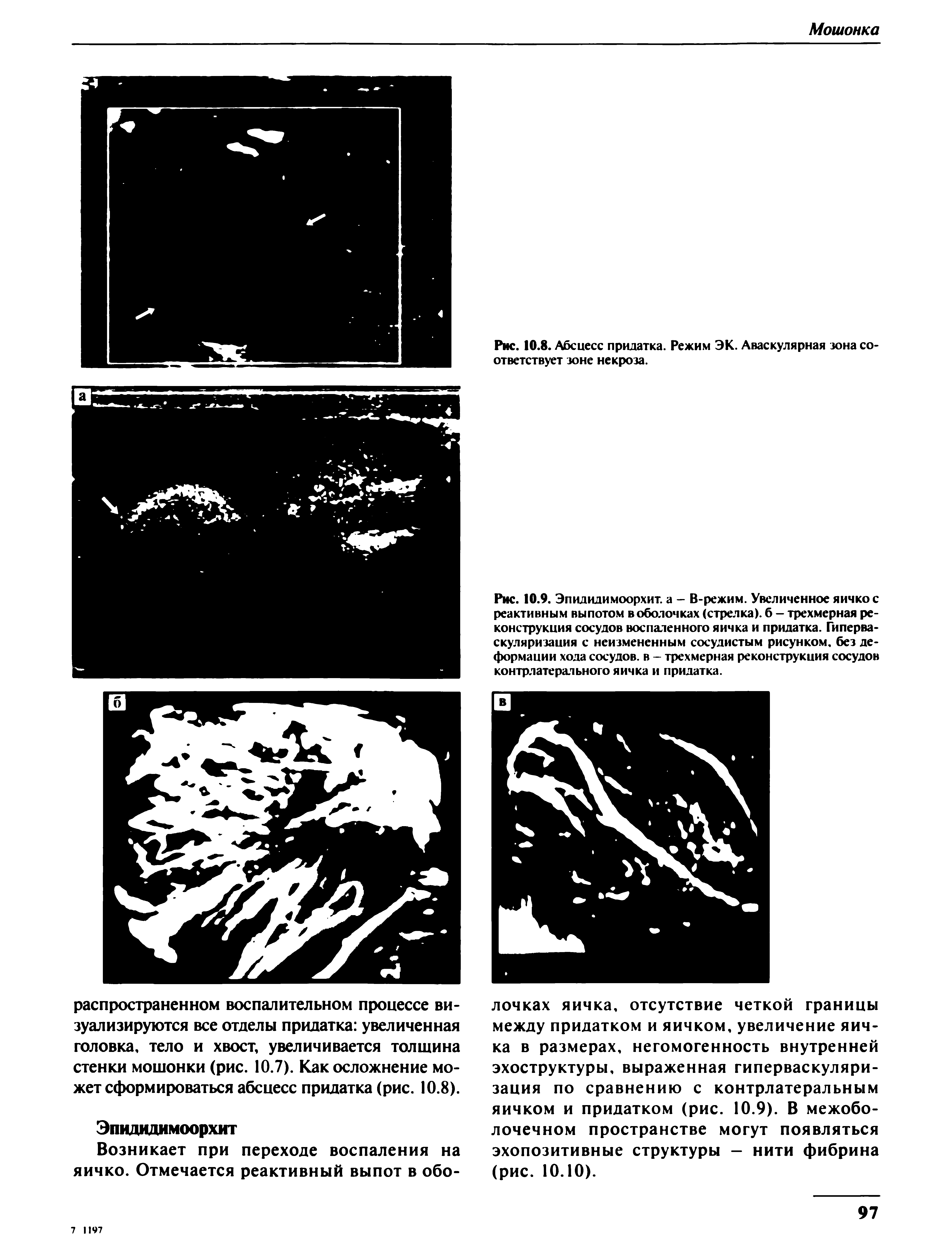 Рис. 10.9. Эпидидимоорхит. а - В-режим. Увеличенное яичко с реактивным выпотом в оболочках (стрелка), б - трехмерная реконструкция сосудов воспаленного яичка и придатка. Гиперваскуляризация с неизмененным сосудистым рисунком, без деформации хода сосудов, в - трехмерная реконструкция сосудов контрлатерального яичка и придатка.