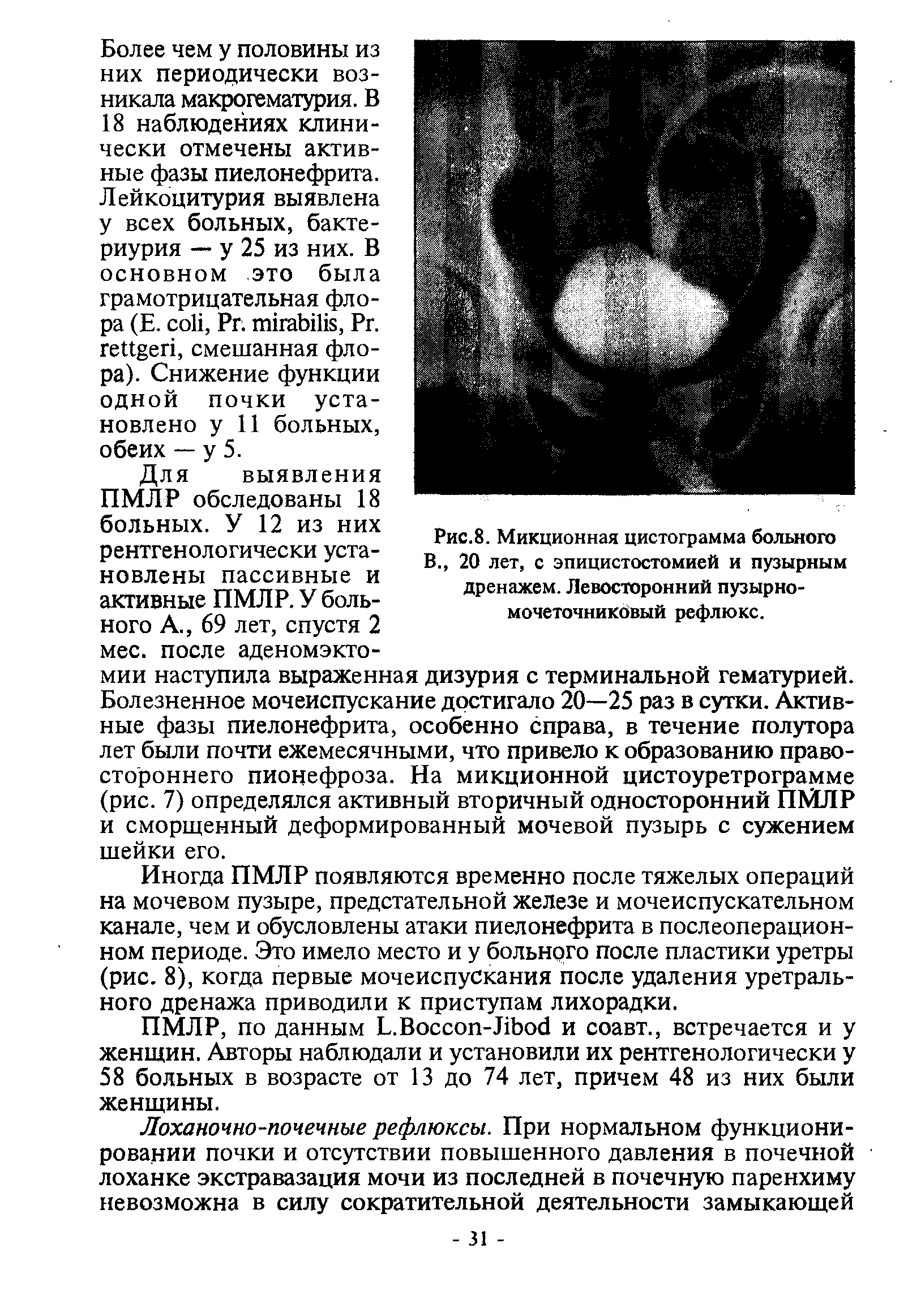 Рис.8. Микционная цистограмма больного В., 20 лет, с эпицистостомией и пузырным дренажем. Левосторонний пузырно-мочеточникдвый рефлюкс.