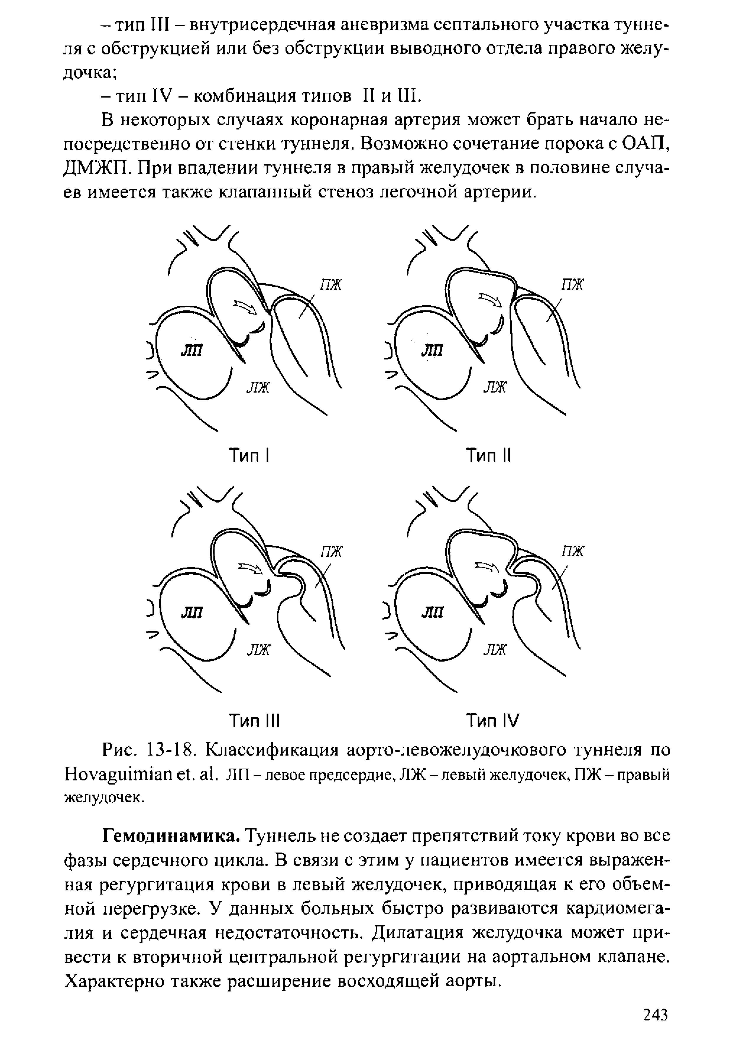 Рис. 13-18. Классификация аорто-левожелудочкового туннеля по Ноуа и1т1ап еЬ а1. ЛП - левое предсердие, ЛЖ-левый желудочек, ПЖ-правый желудочек.