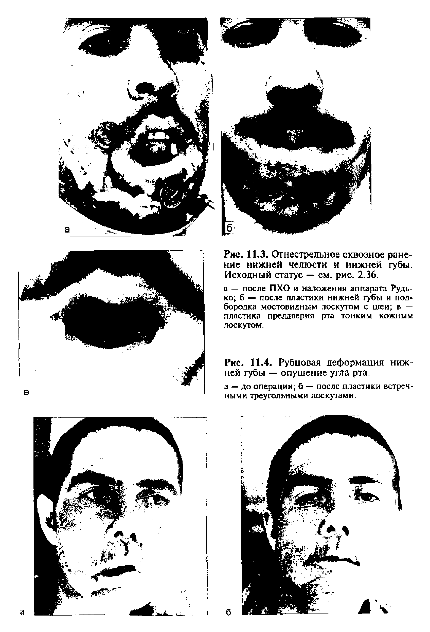 Рис. 11.4. Рубцовая деформация нижней губы — опущение угла рта.