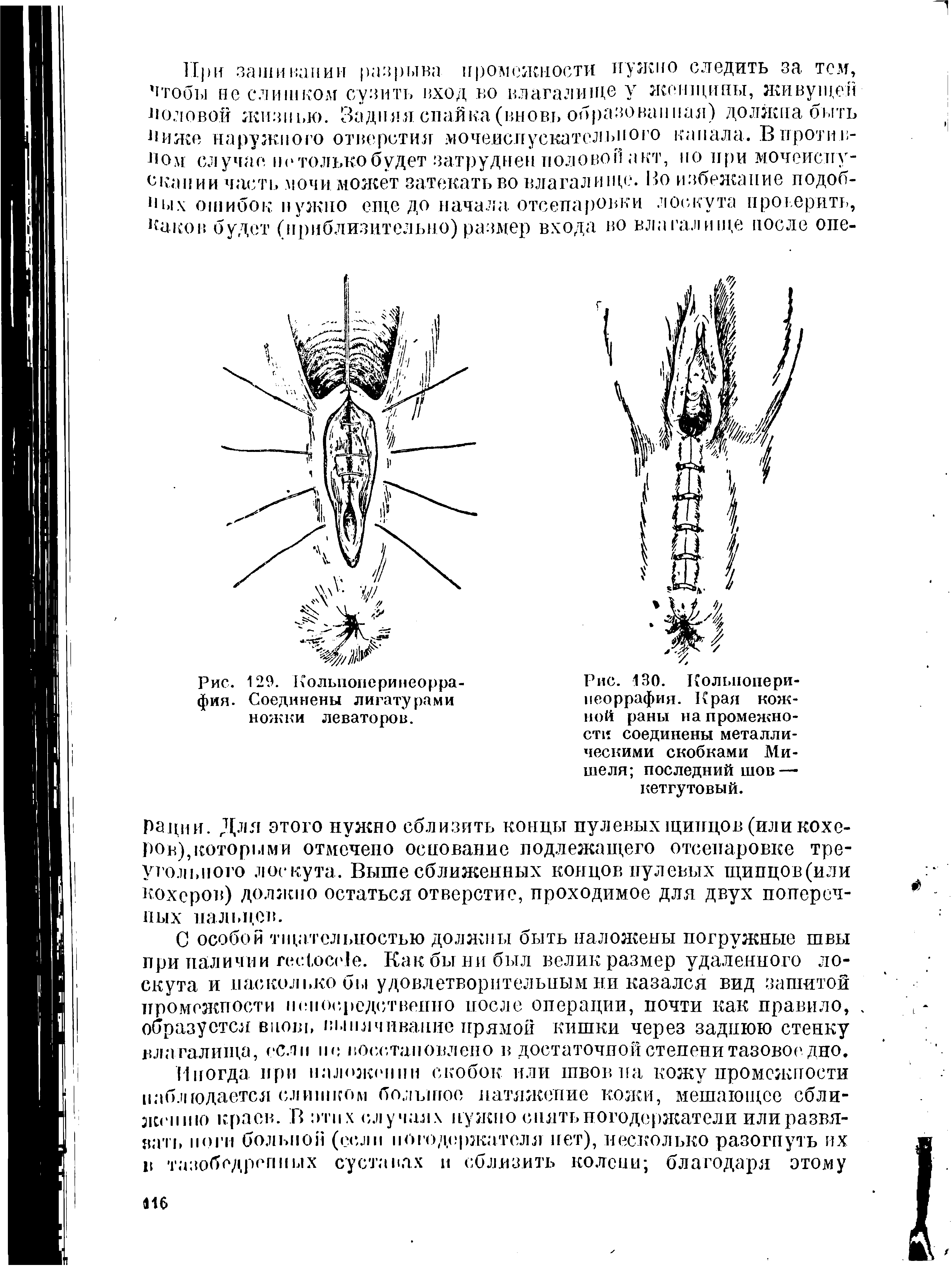 Рис. 130. Кольпопери-неоррафия. Края кожной раны на промежности соединены металлическими скобками Мишеля последний шов — кетгутовый.