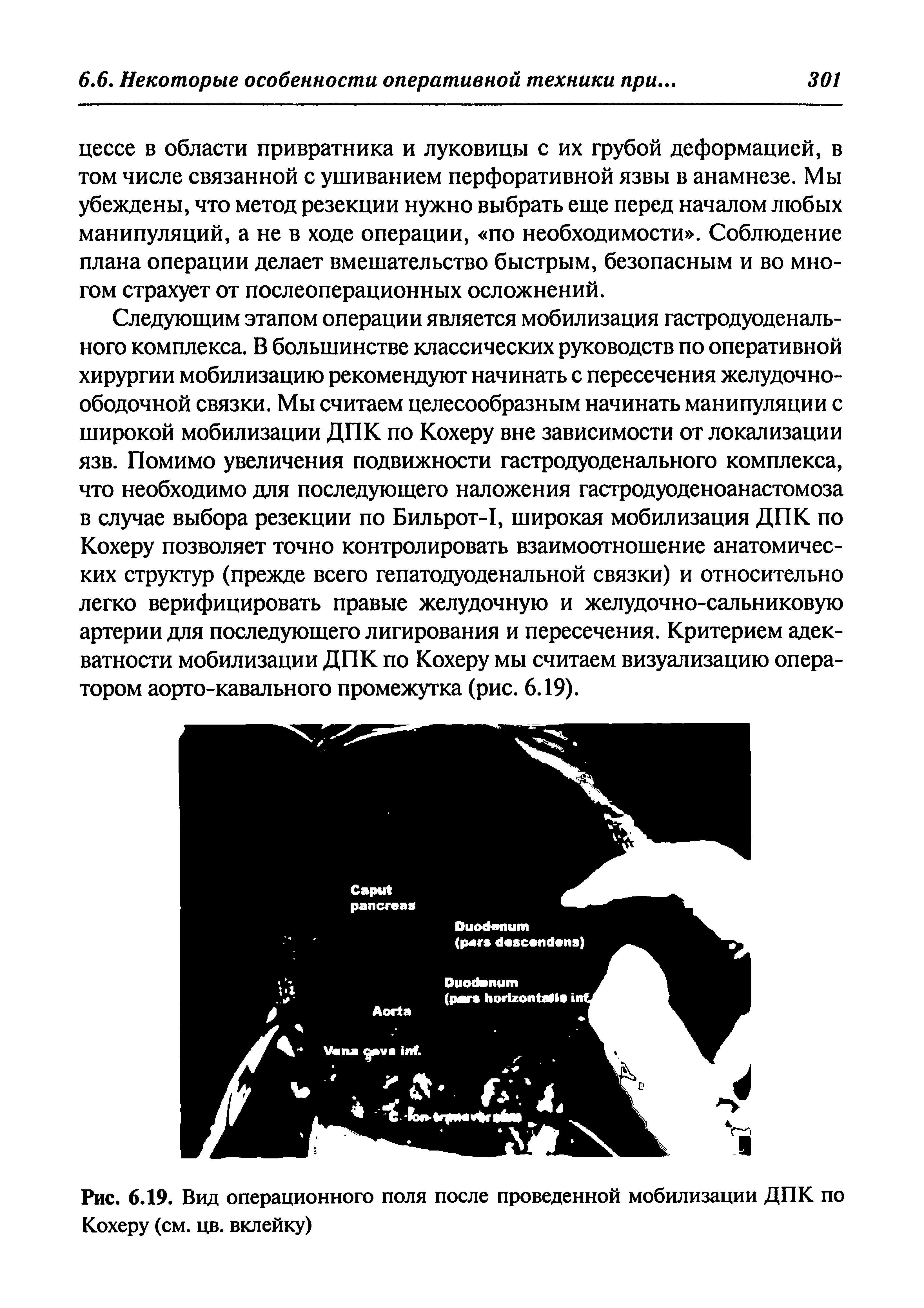 Рис. 6.19. Вид операционного поля после проведенной мобилизации ДПК по Кохеру (см. цв. вклейку)...