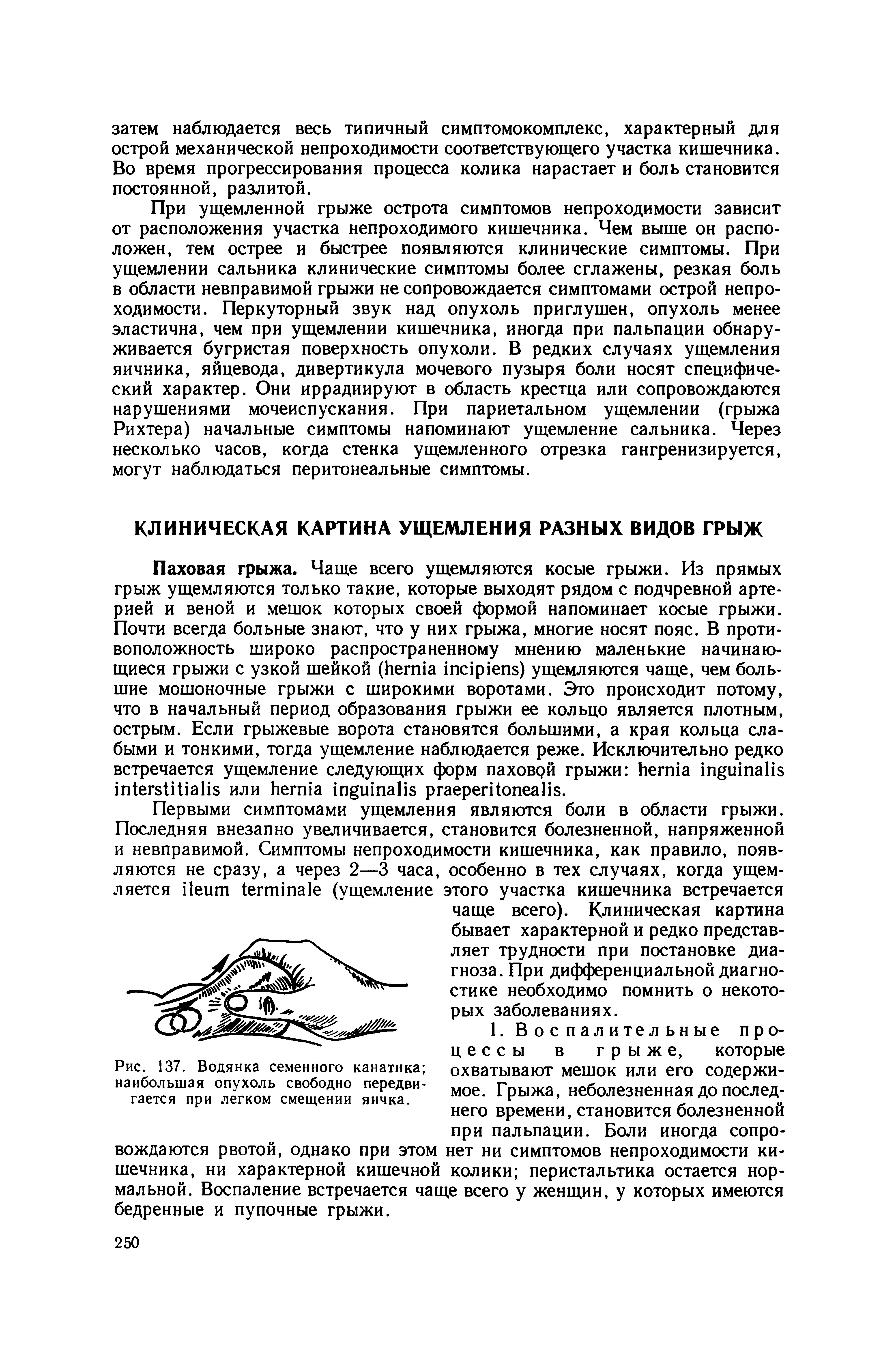 Рис. 137. Водянка семенного канатика наибольшая опухоль свободно передвигается при легком смещении яичка.