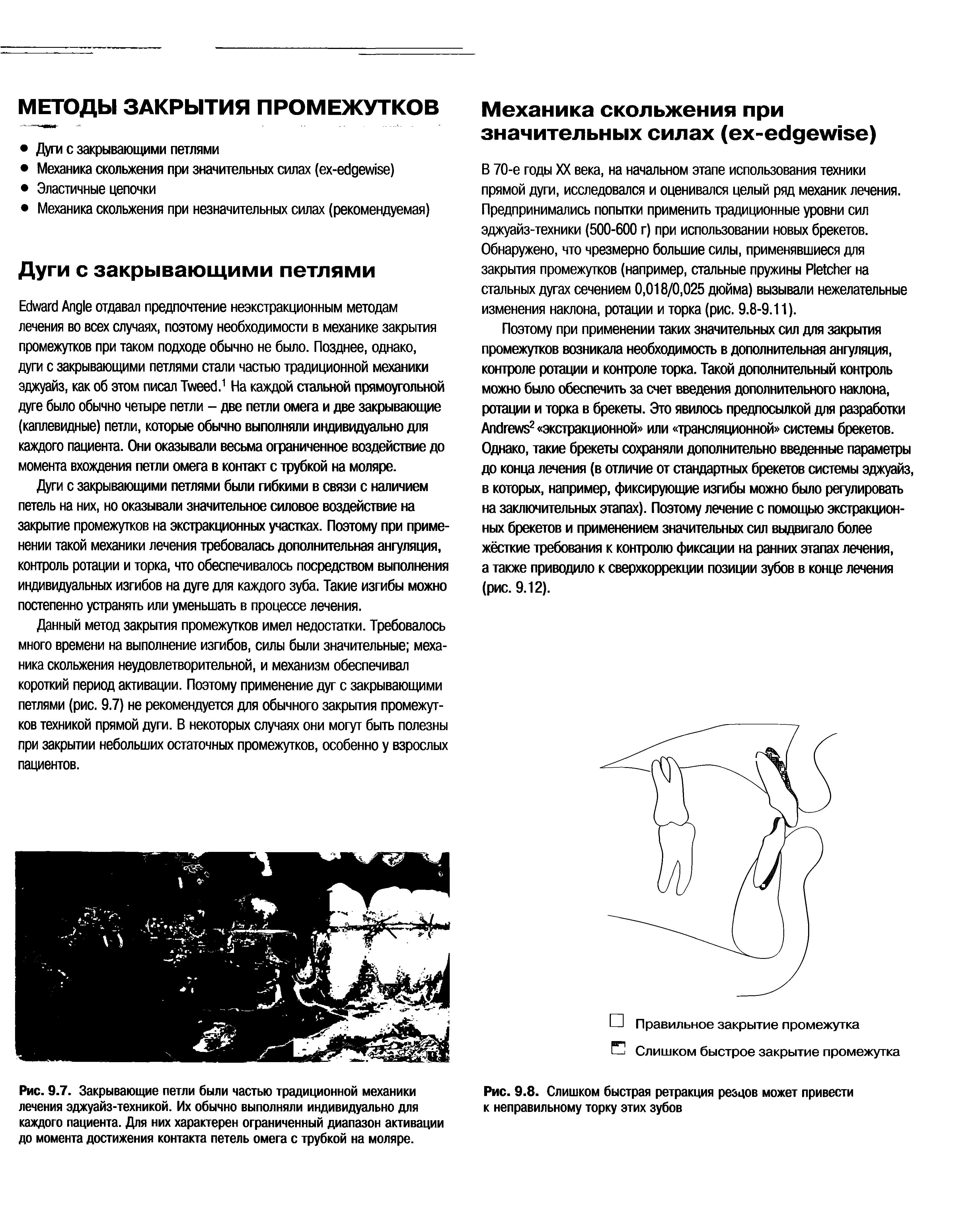 Рис. 9.7. Закрывающие петли были частью традиционной механики лечения эджуайз-техникой. Их обычно выполняли индивидуально для каждого пациента. Для них характерен ограниченный диапазон активации до момента достижения контакта петель омега с трубкой на моляре.
