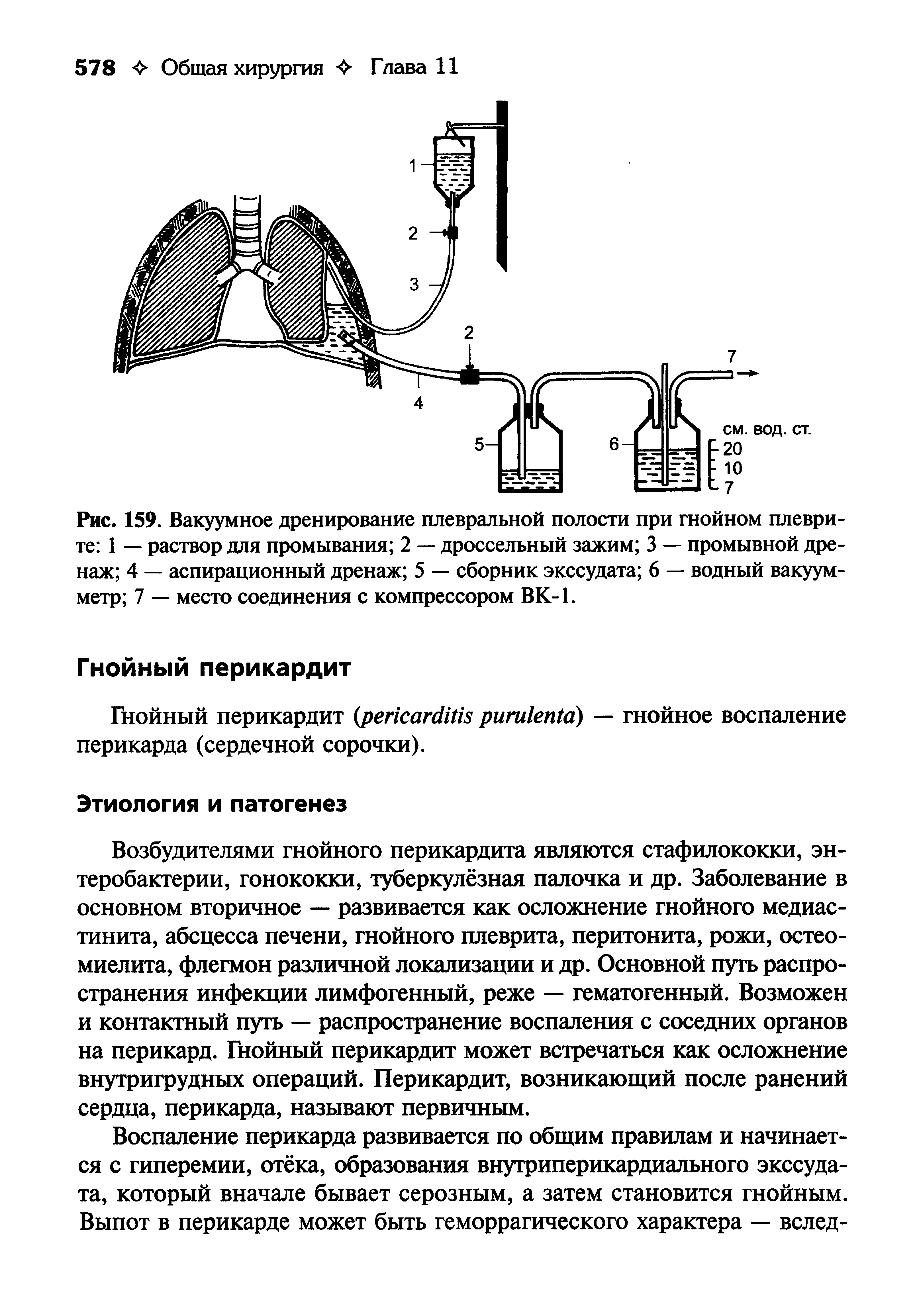 Рис. 159. Вакуумное дренирование плевральной полости при гнойном плеврите 1 — раствор для промывания 2 — дроссельный зажим 3 — промывной дренаж 4 — аспирационный дренаж 5 — сборник экссудата 6 — водный вакуумметр 7 — место соединения с компрессором ВК-1.