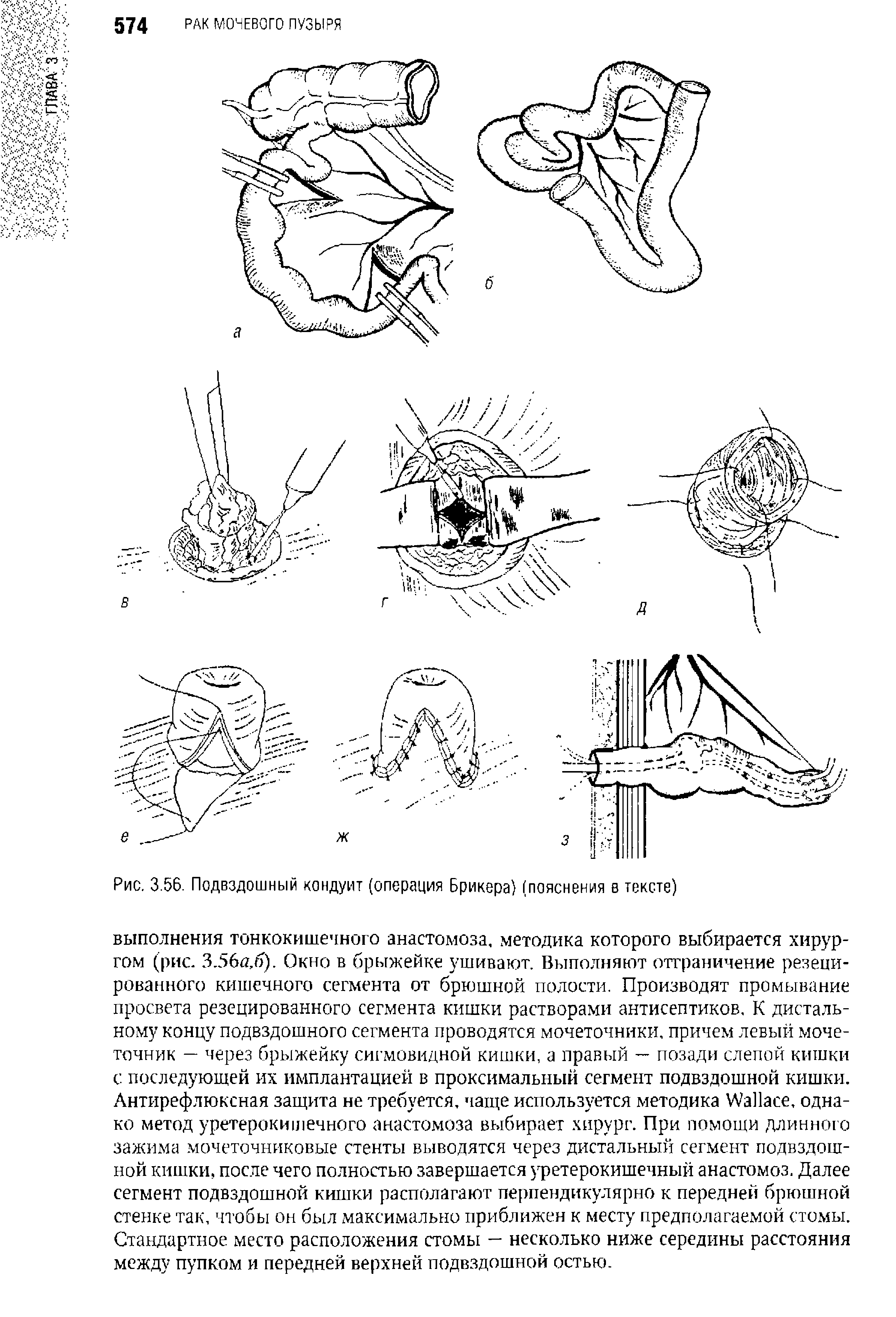 Рис. 3.56. Подвздошный кондуит (операция Брикера) (пояснения в тексте)...
