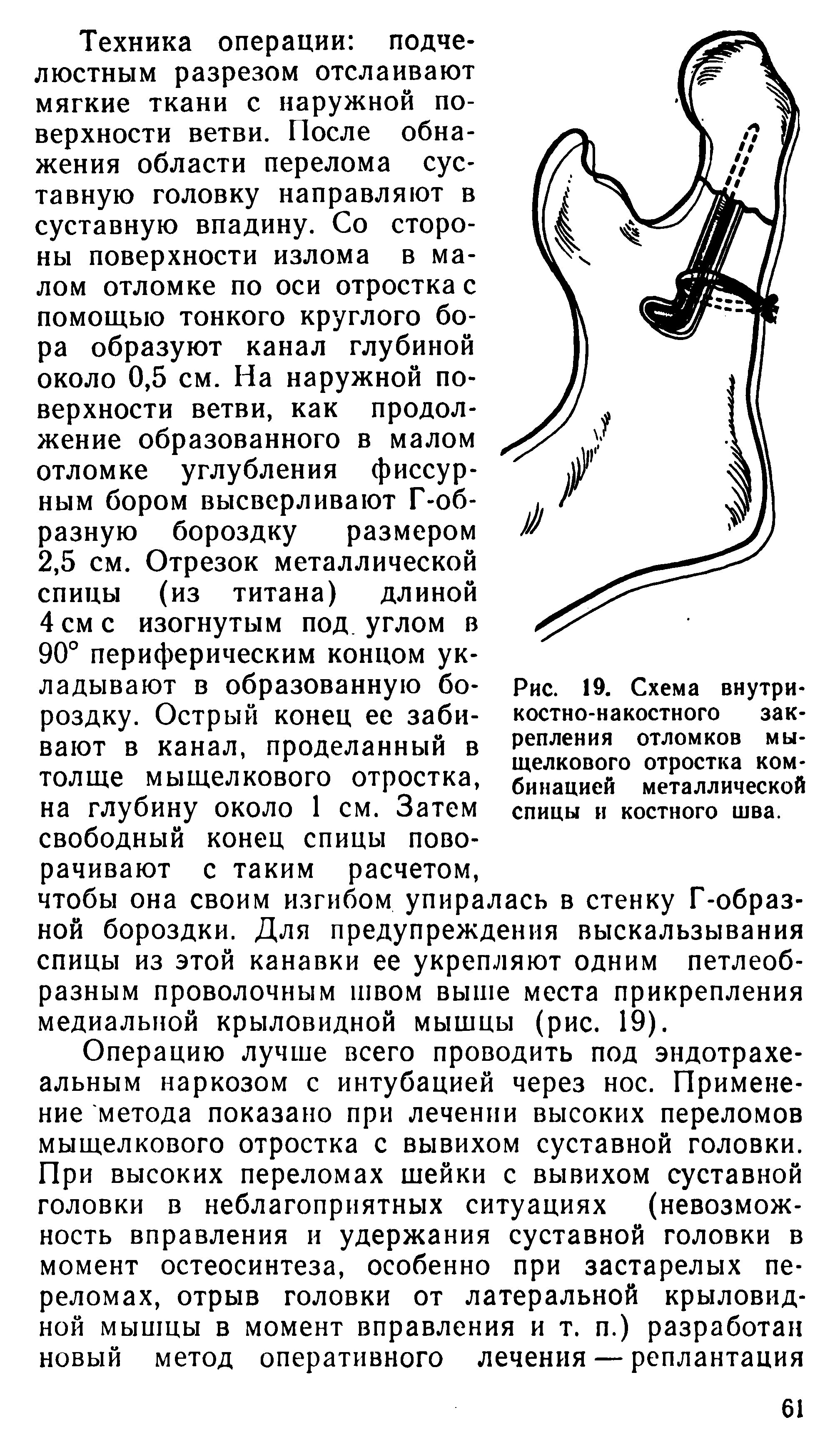 Рис. 19. Схема внутрикостно-накостного закрепления отломков мыщелкового отростка комбинацией металлической спицы и костного шва.