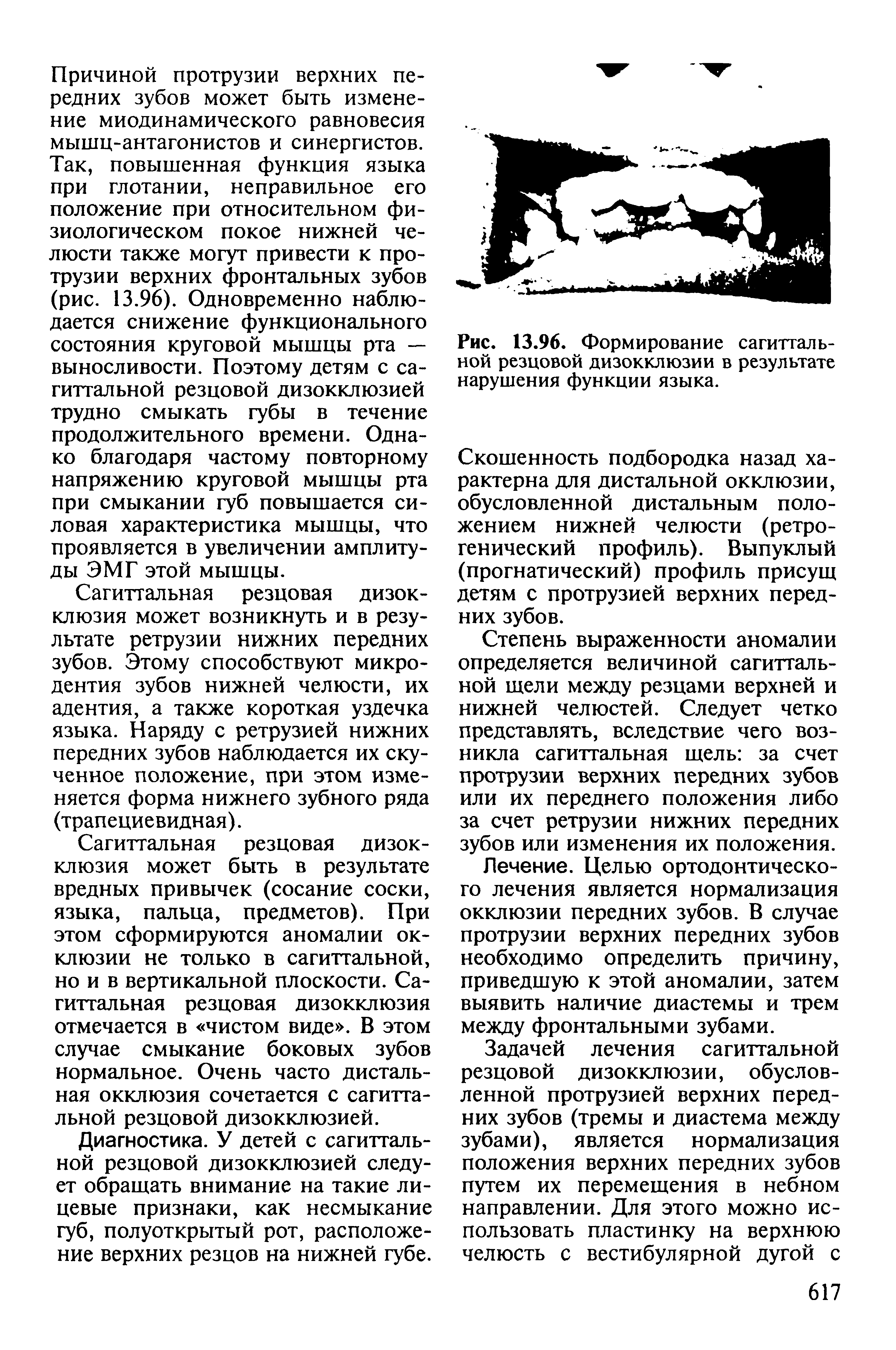 Рис. 13.96. Формирование сагиттальной резцовой дизокклюзии в результате нарушения функции языка.